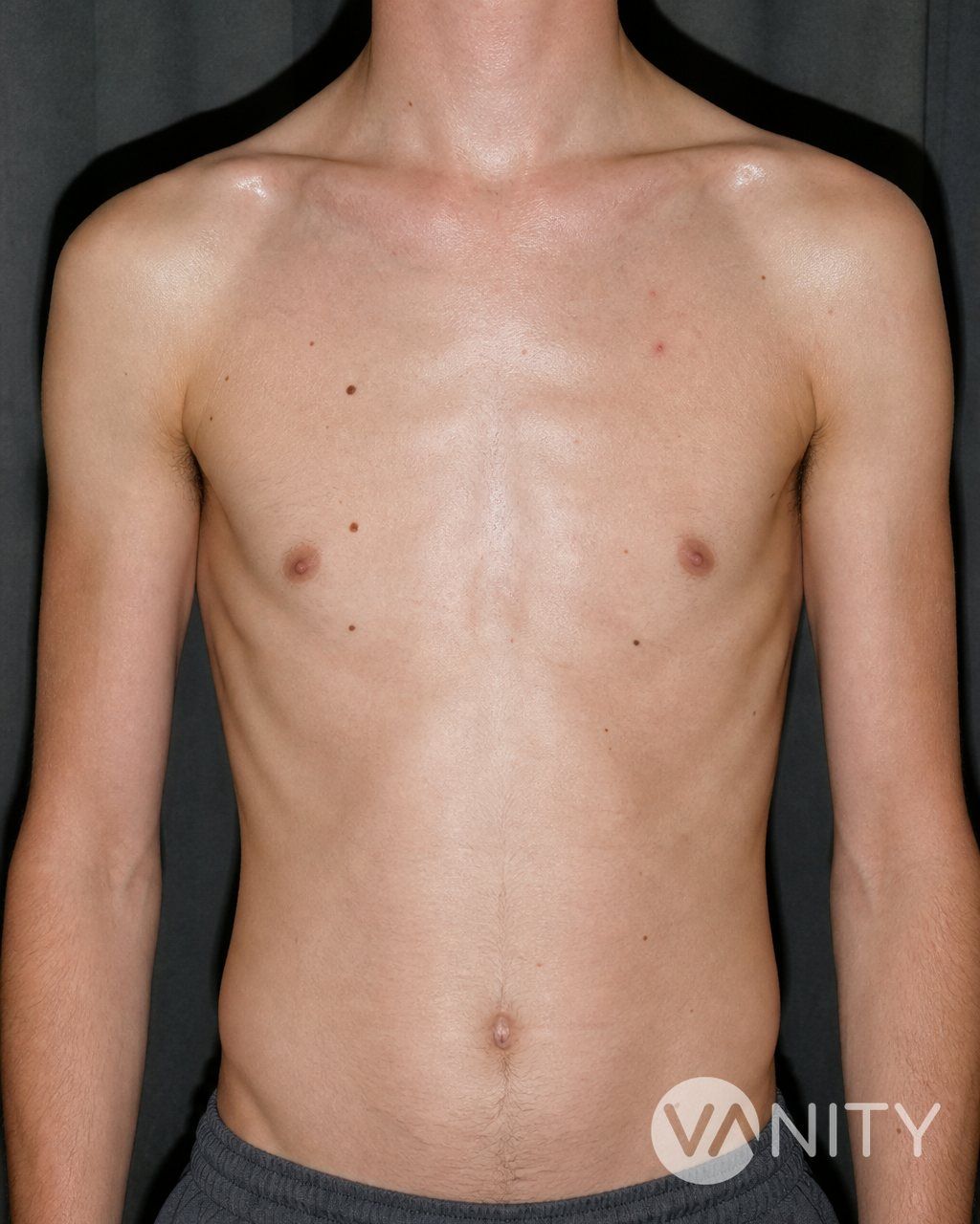 Before Pectoral implants — illustrative, not a real patient