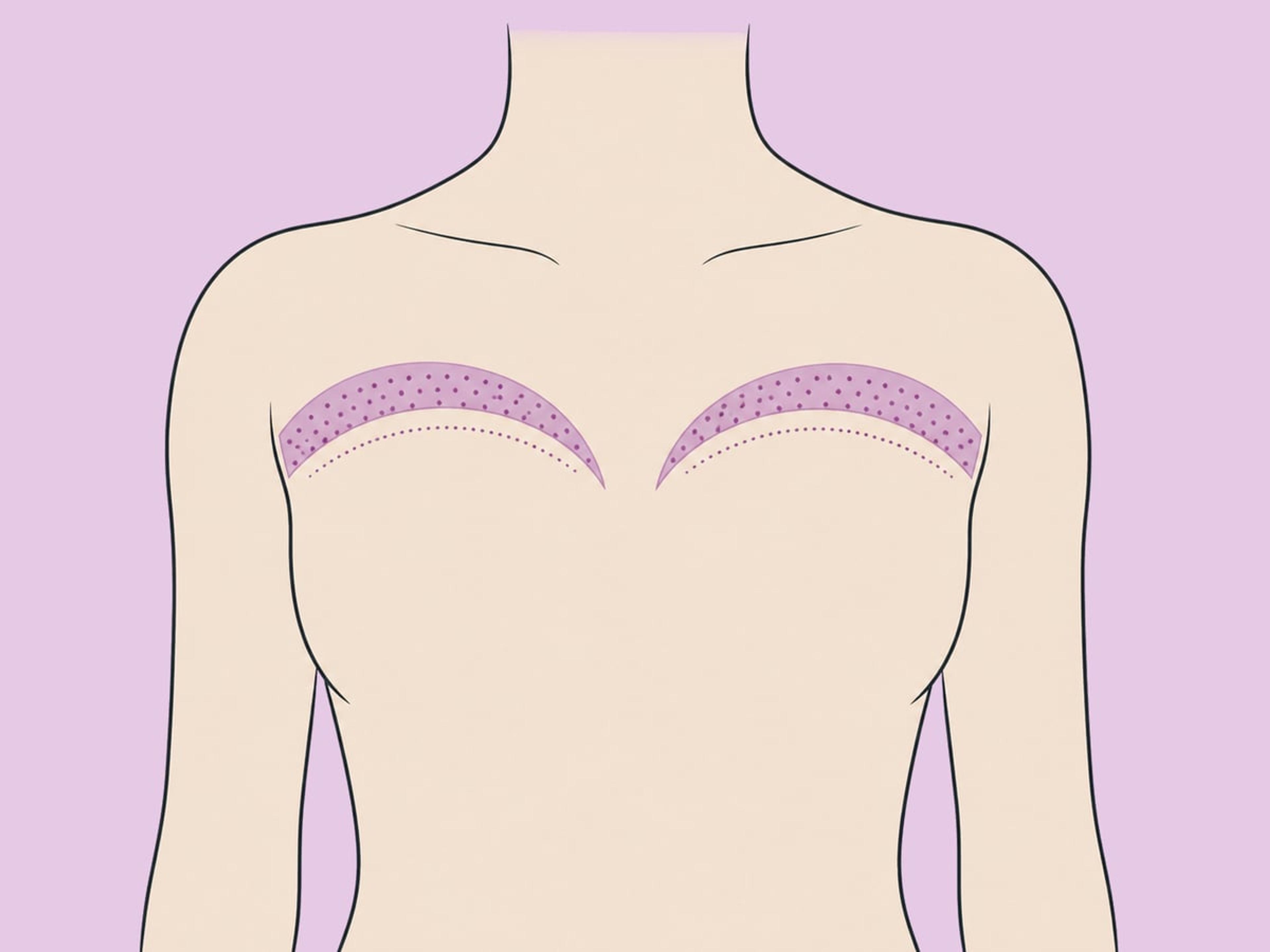 Brust-Fetttransplantation — illustration