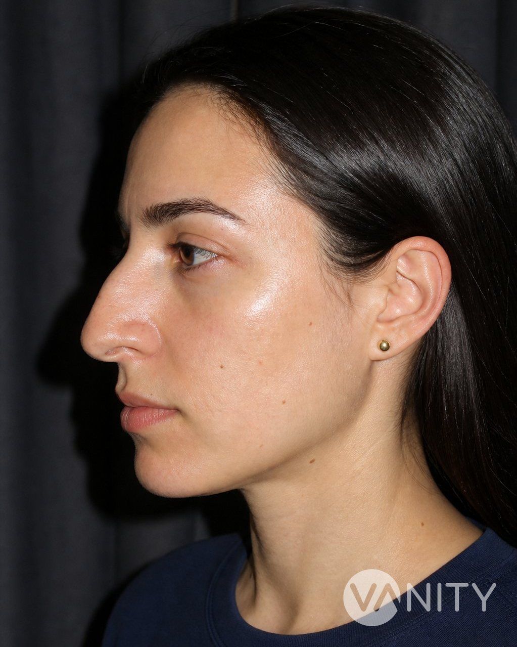 Before Rhinoplasty — illustrative, not a real patient