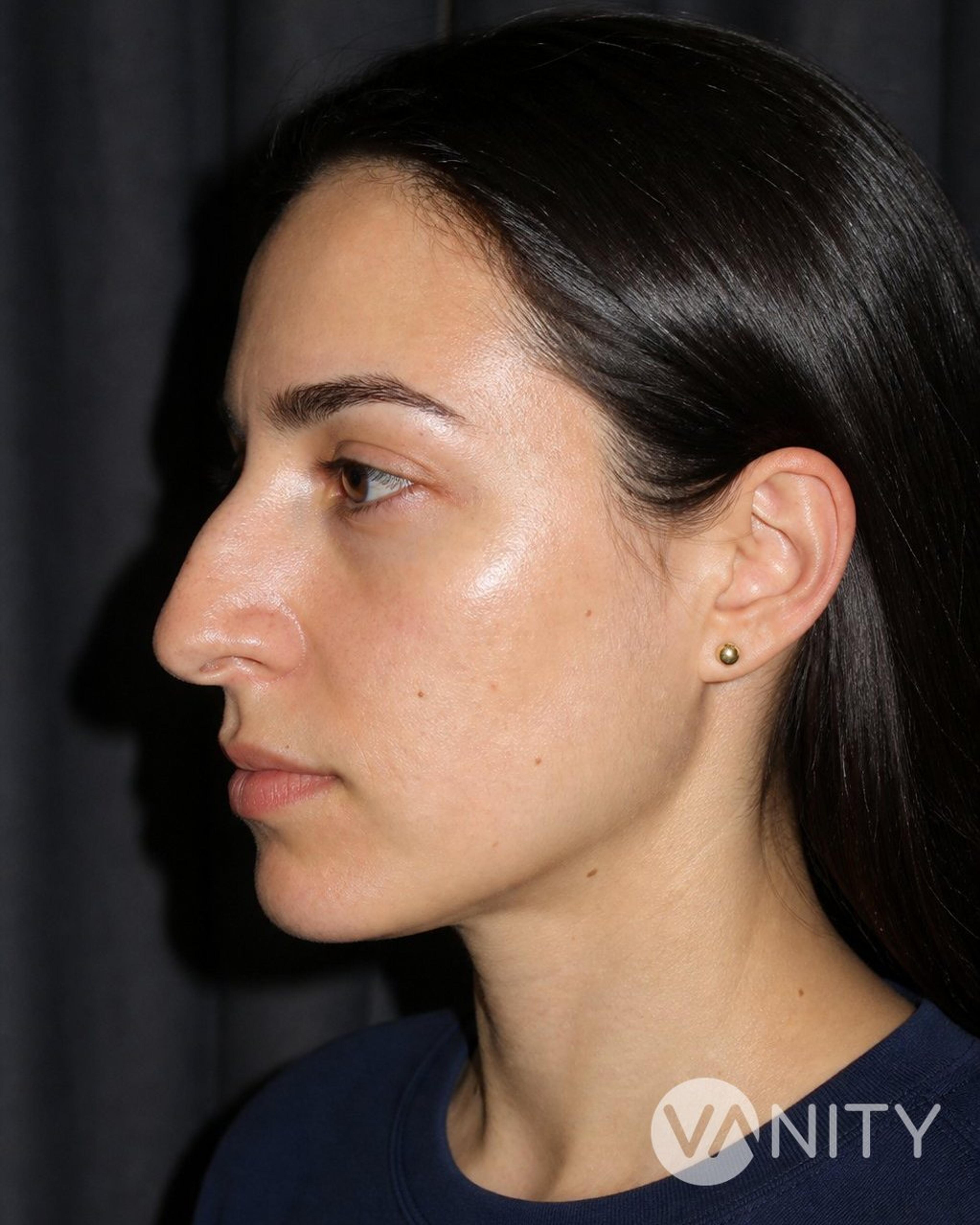 Before Rhinoplasty — illustrative, not a real patient