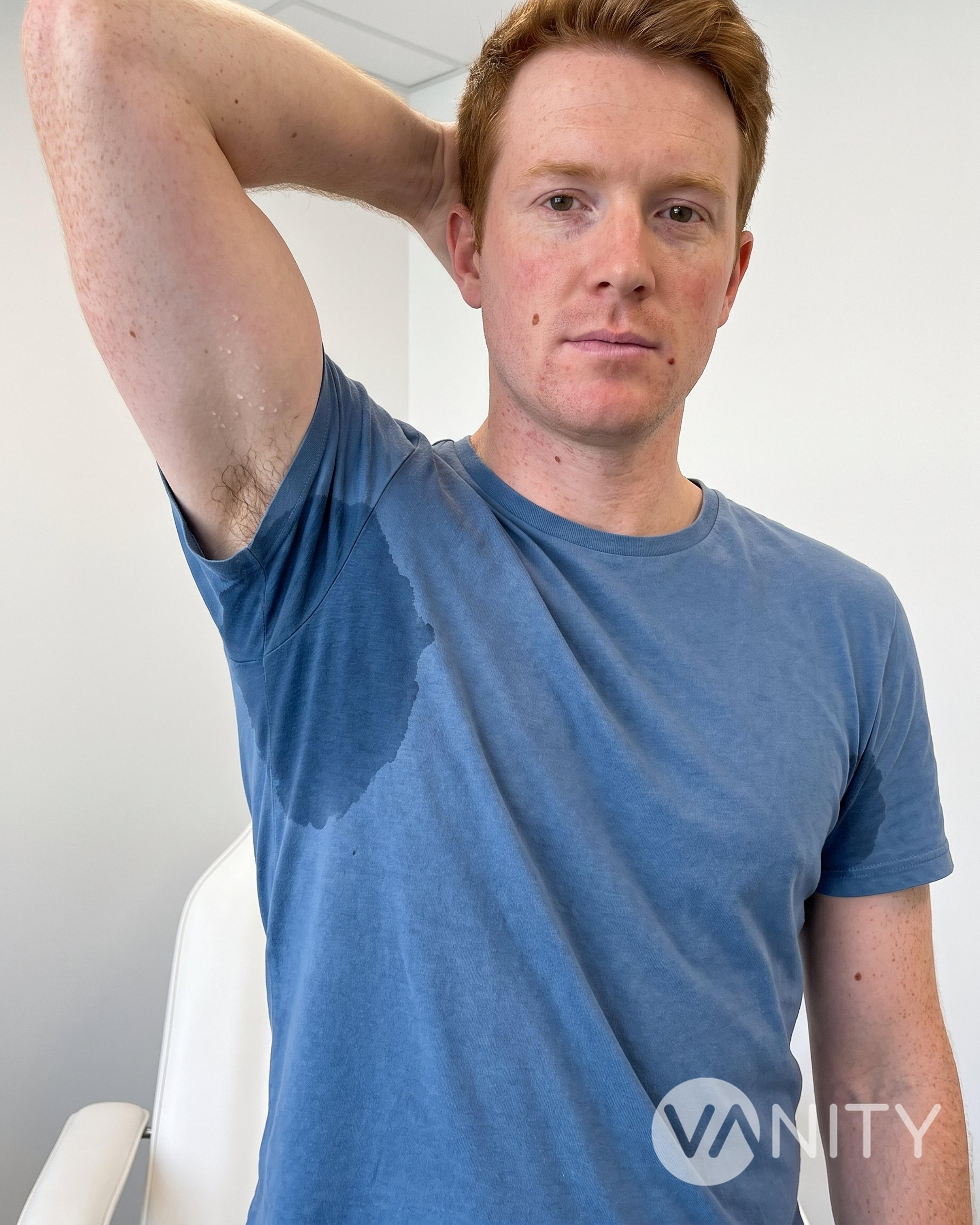 Before Hyperhidrosis (excessive sweating) — illustrative, not a real patient