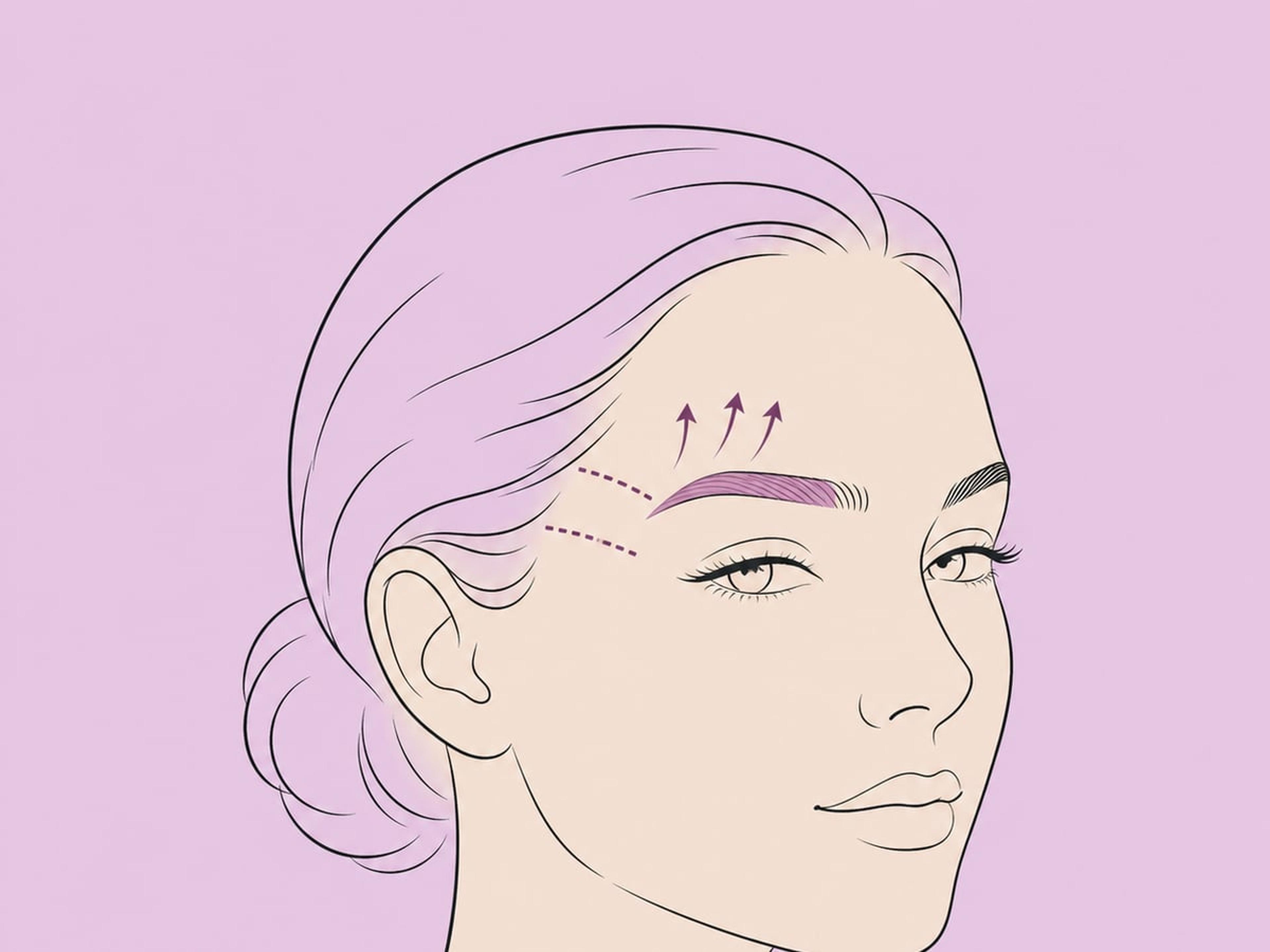 Temporaler (lateraler) Stirnlift — illustration