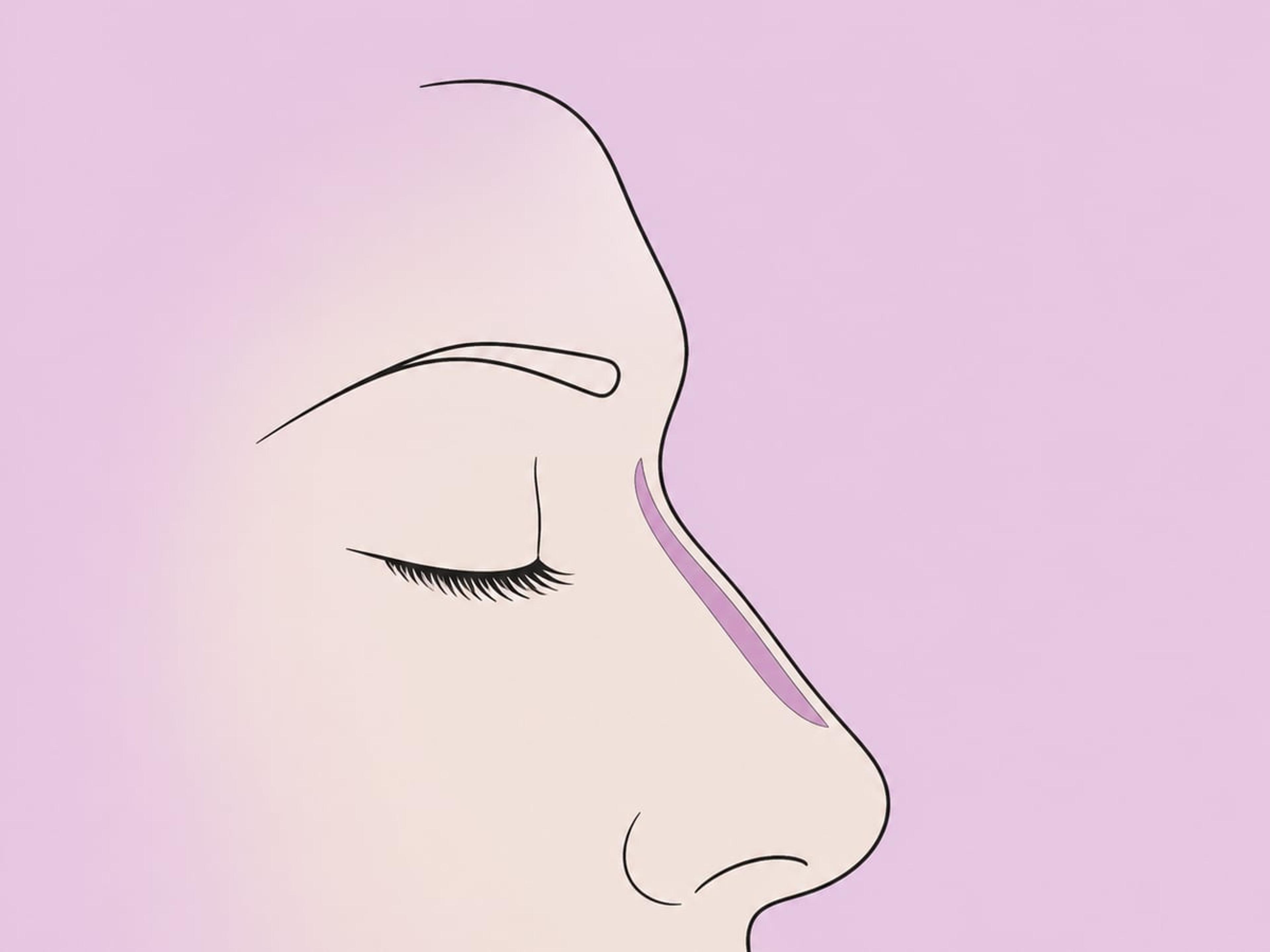 Ultraschall- (Piezo-) Rhinoplastik — illustration