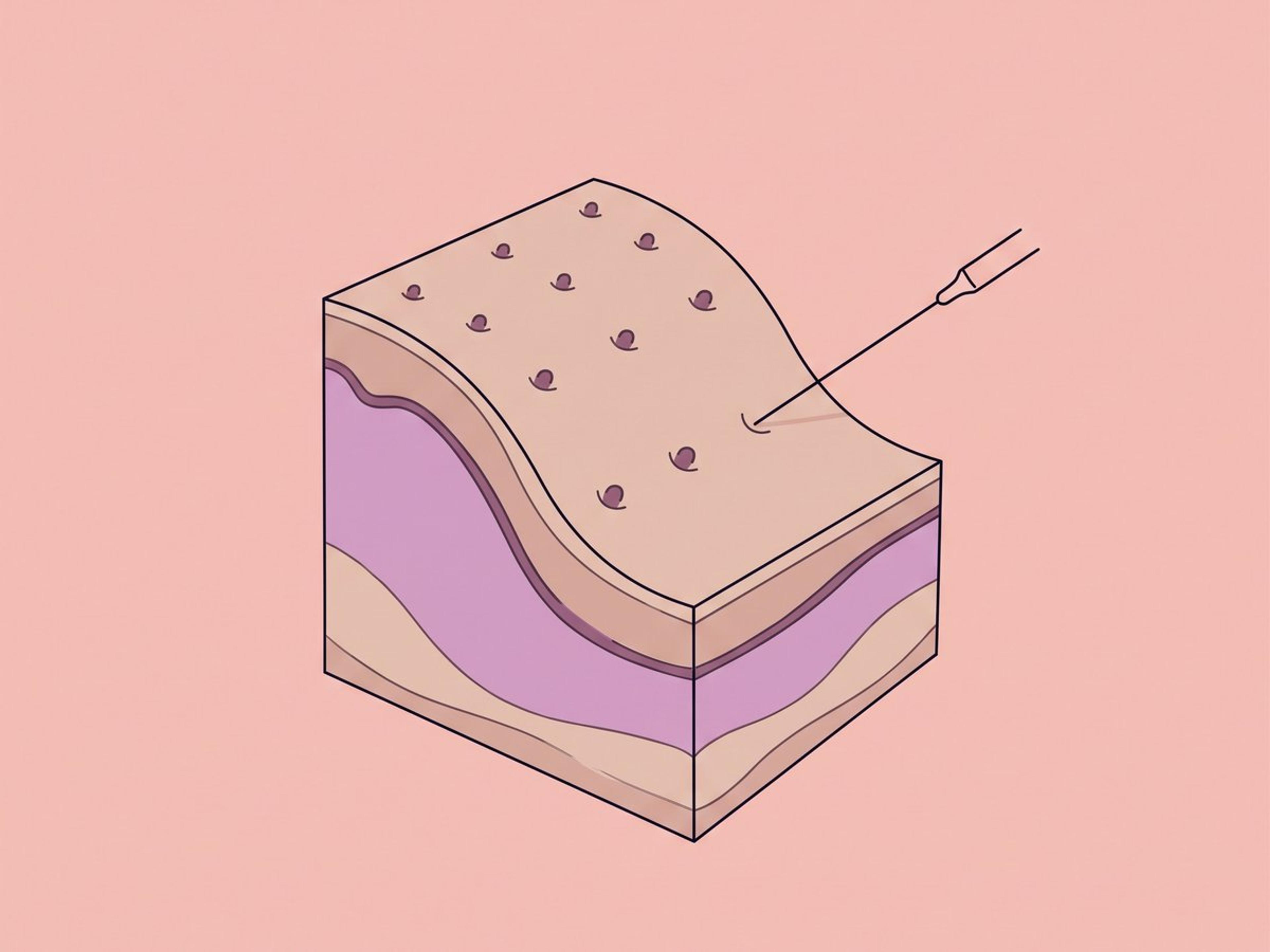 Intradermale Mikroinjektion — illustration