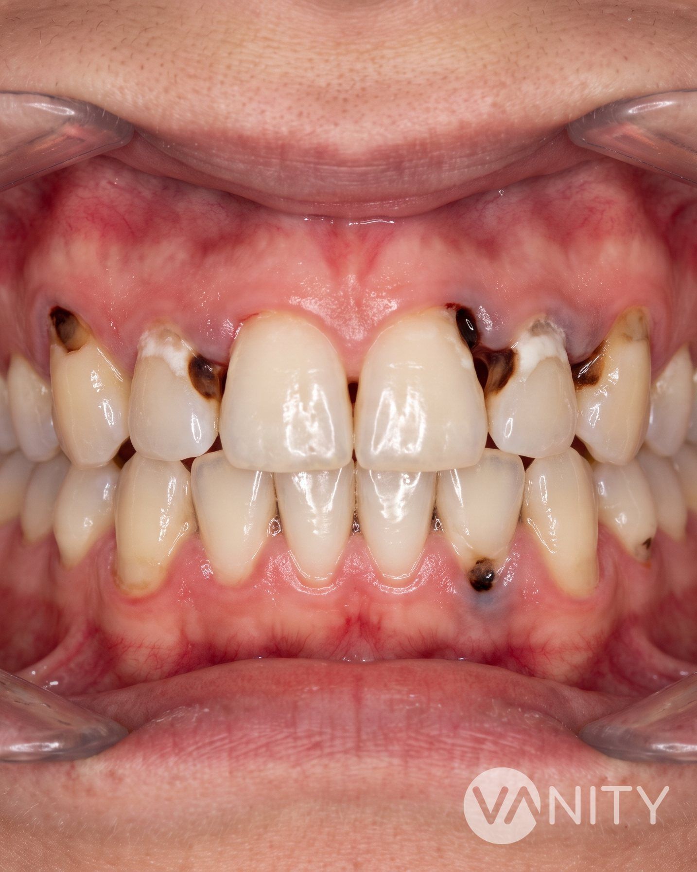 Before Dental fillings — illustrative, not a real patient