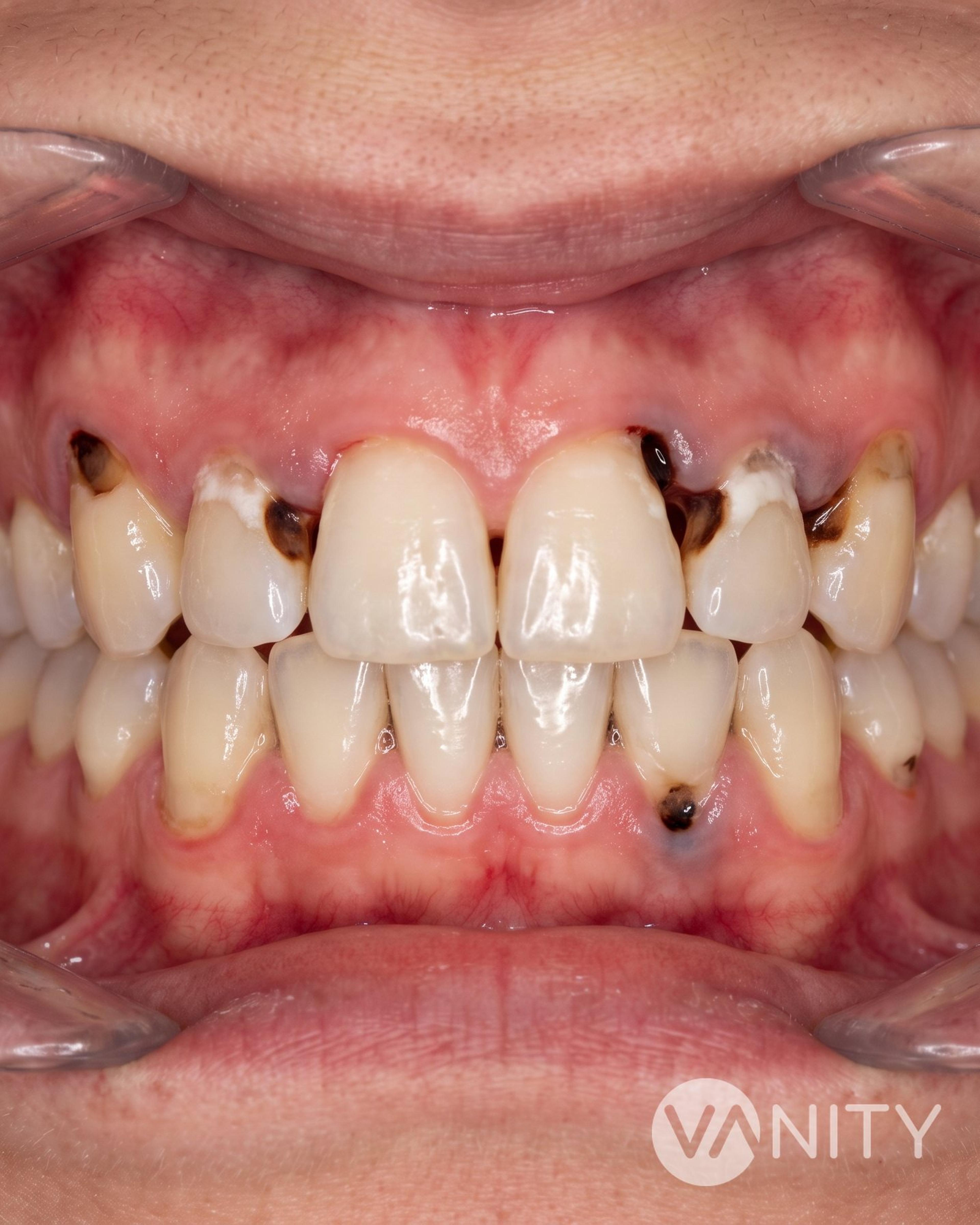 Before Dental fillings — illustrative, not a real patient