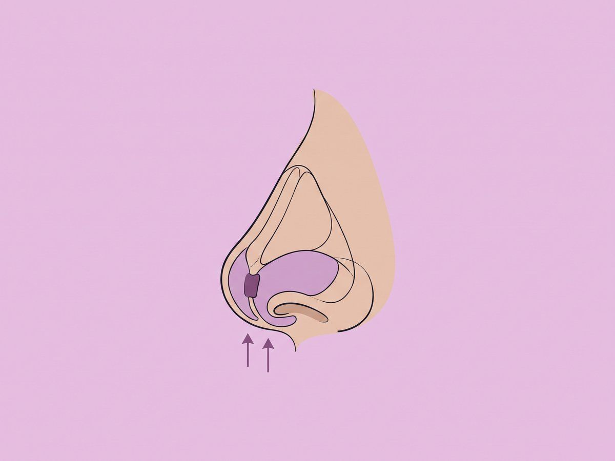 Offene strukturelle Revision mit Knorpeltransplantation — illustration