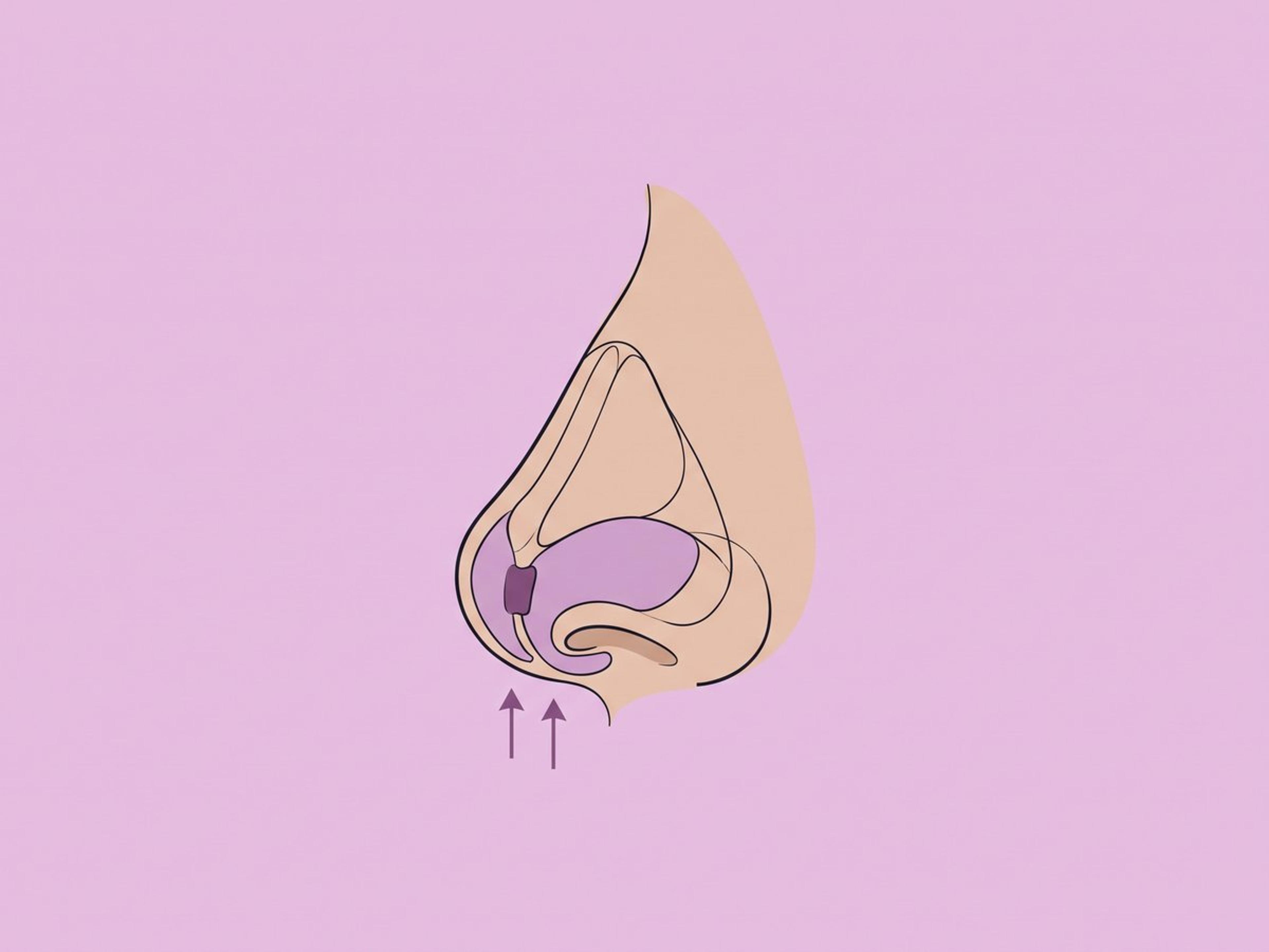 Offene strukturelle Revision mit Knorpeltransplantation — illustration