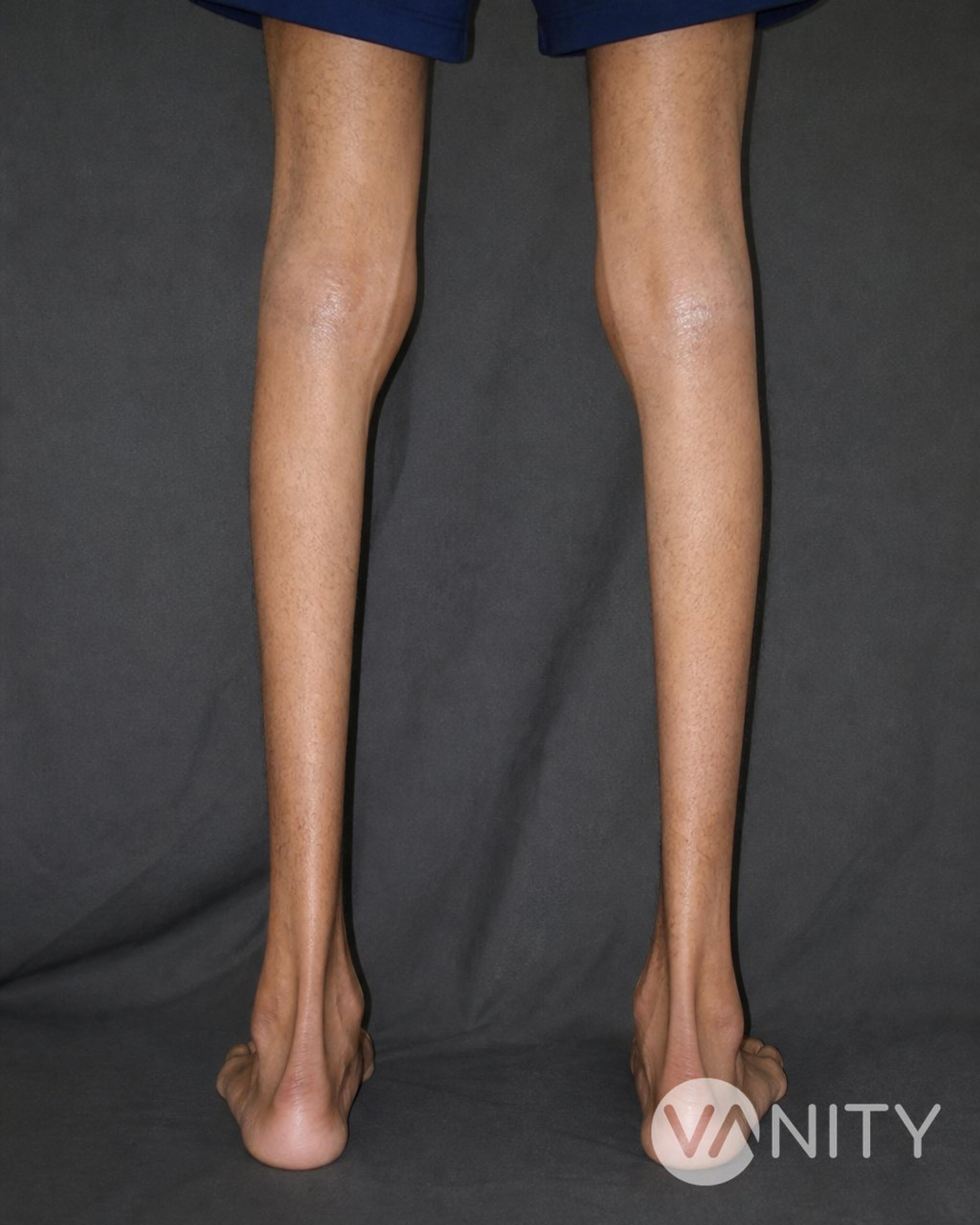 Before Calf implants — illustrative, not a real patient