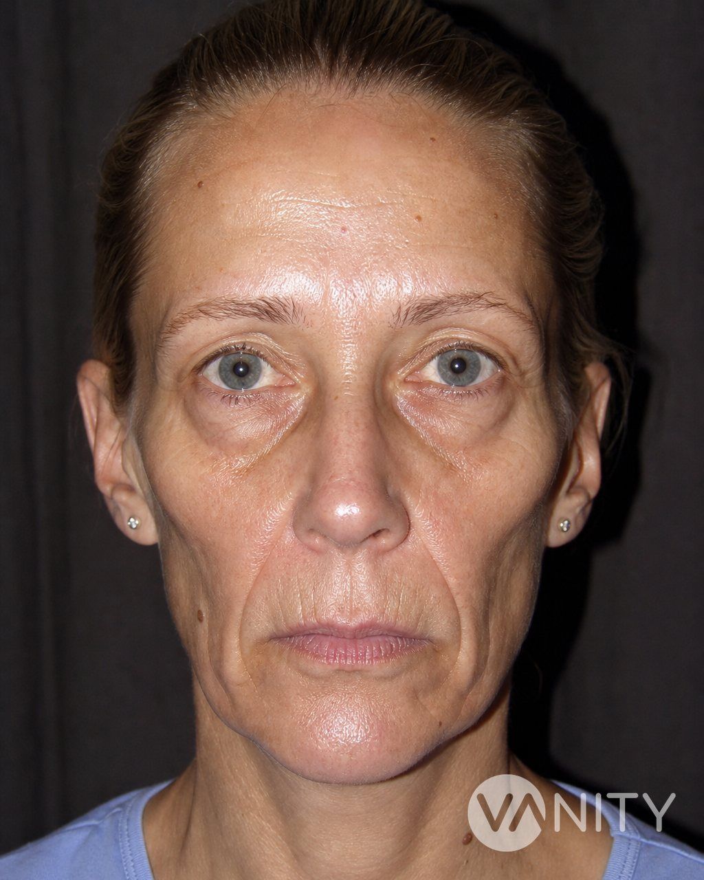 Before Fat Transfer ( Lipofilling) — illustrative, not a real patient