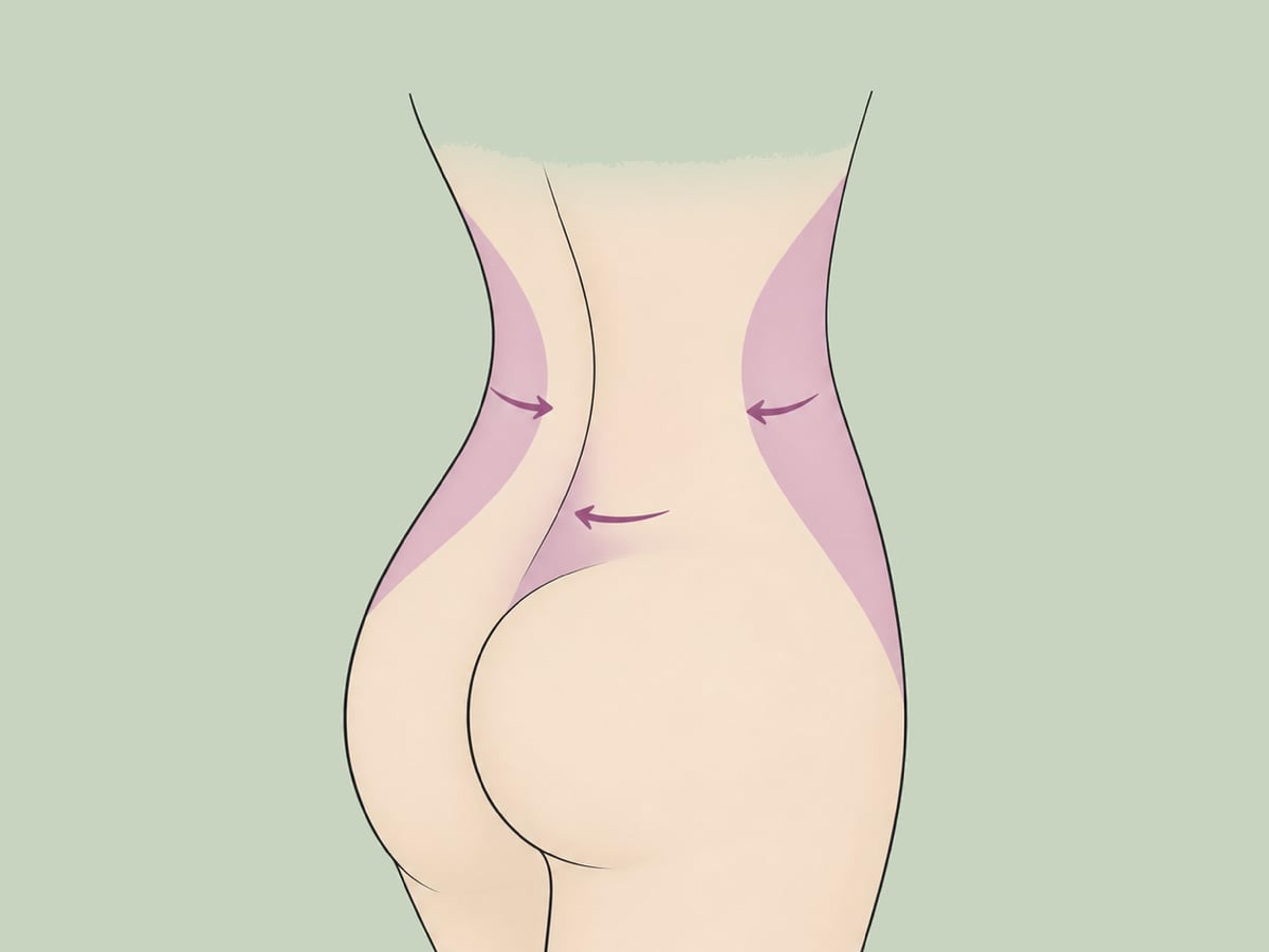 Eigenfettinjektion bei Hüfteinziehungen und Skinny BBL — illustration