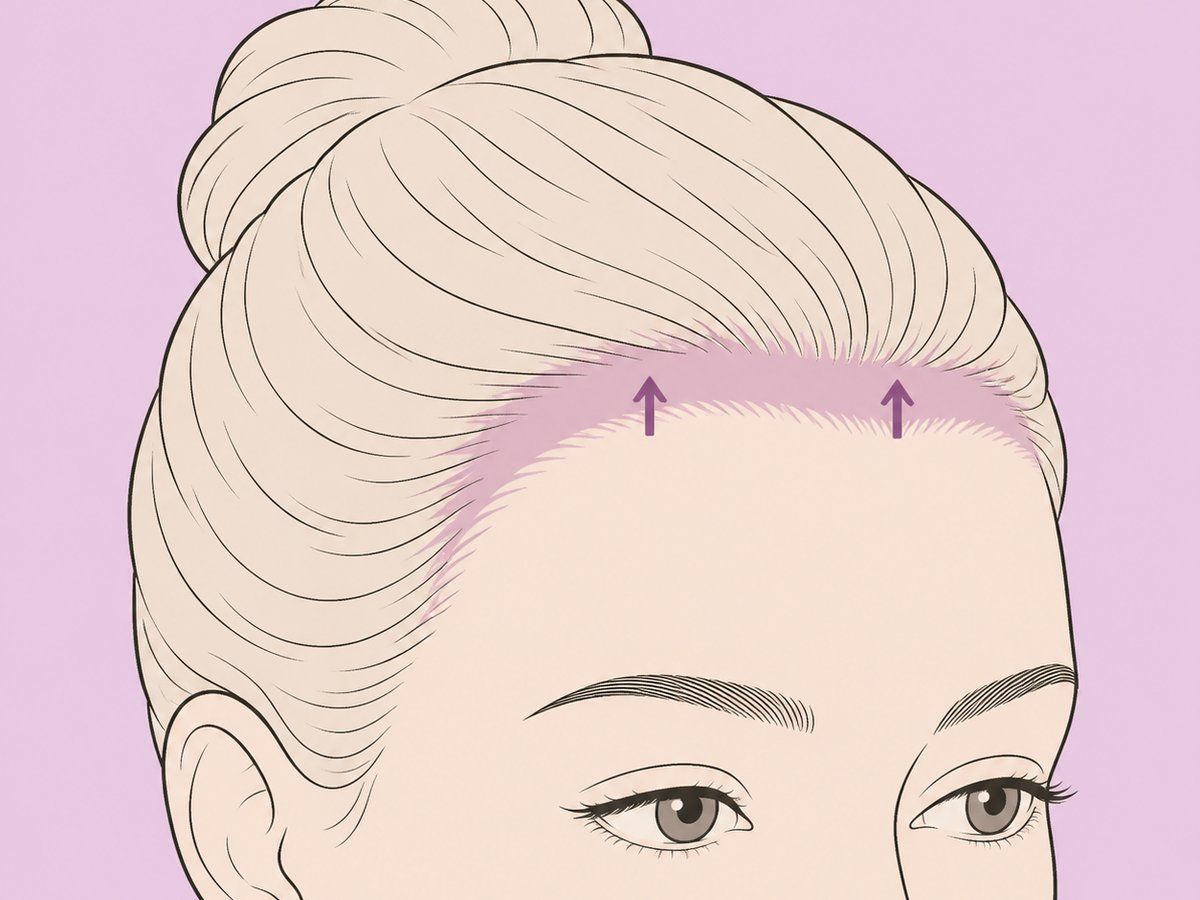 Trichophytischer (Haarlinien-) Stirnlift — illustration