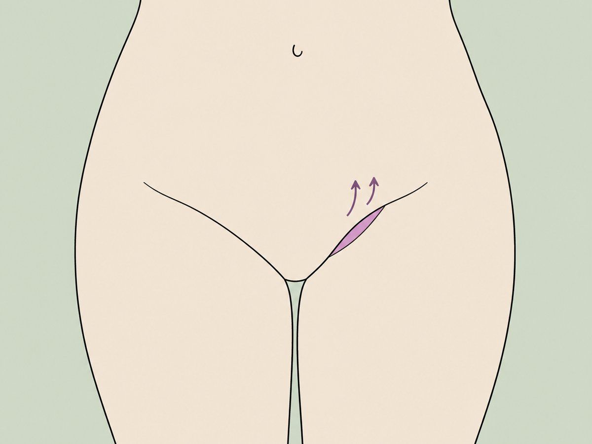 Mini lifting delle cosce (a mezzaluna) — illustration