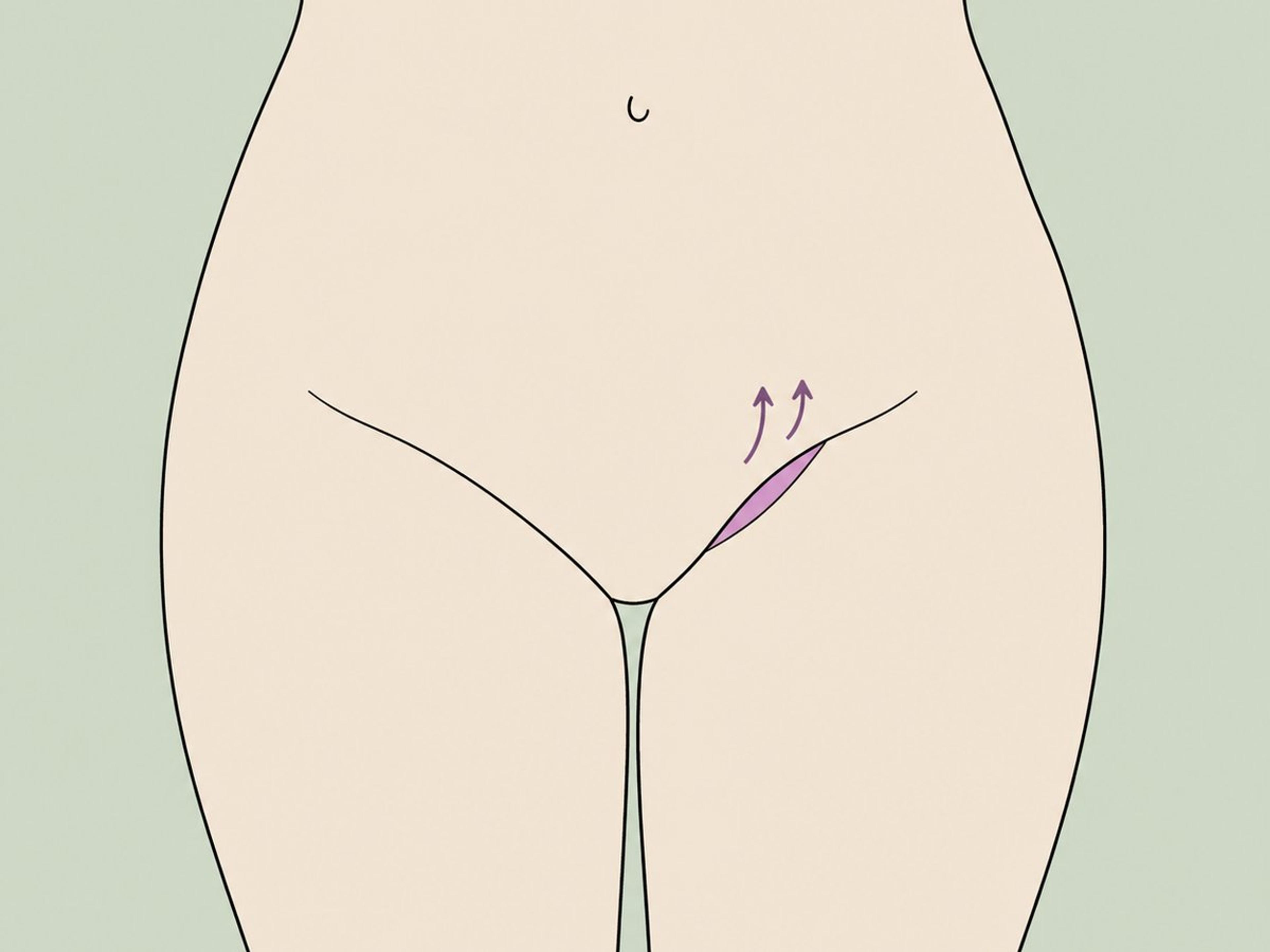 Mini lifting delle cosce (a mezzaluna) — illustration