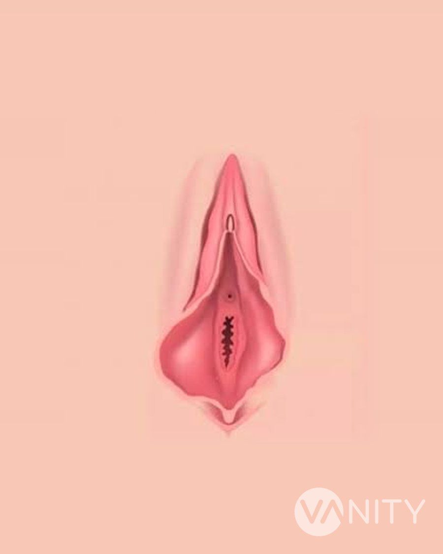 Vaginoplastik vorher — Vanity, Istanbul