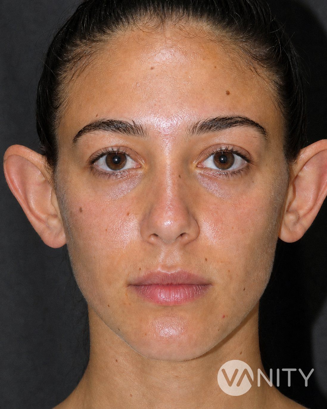 Before Ear surgery — illustrative, not a real patient