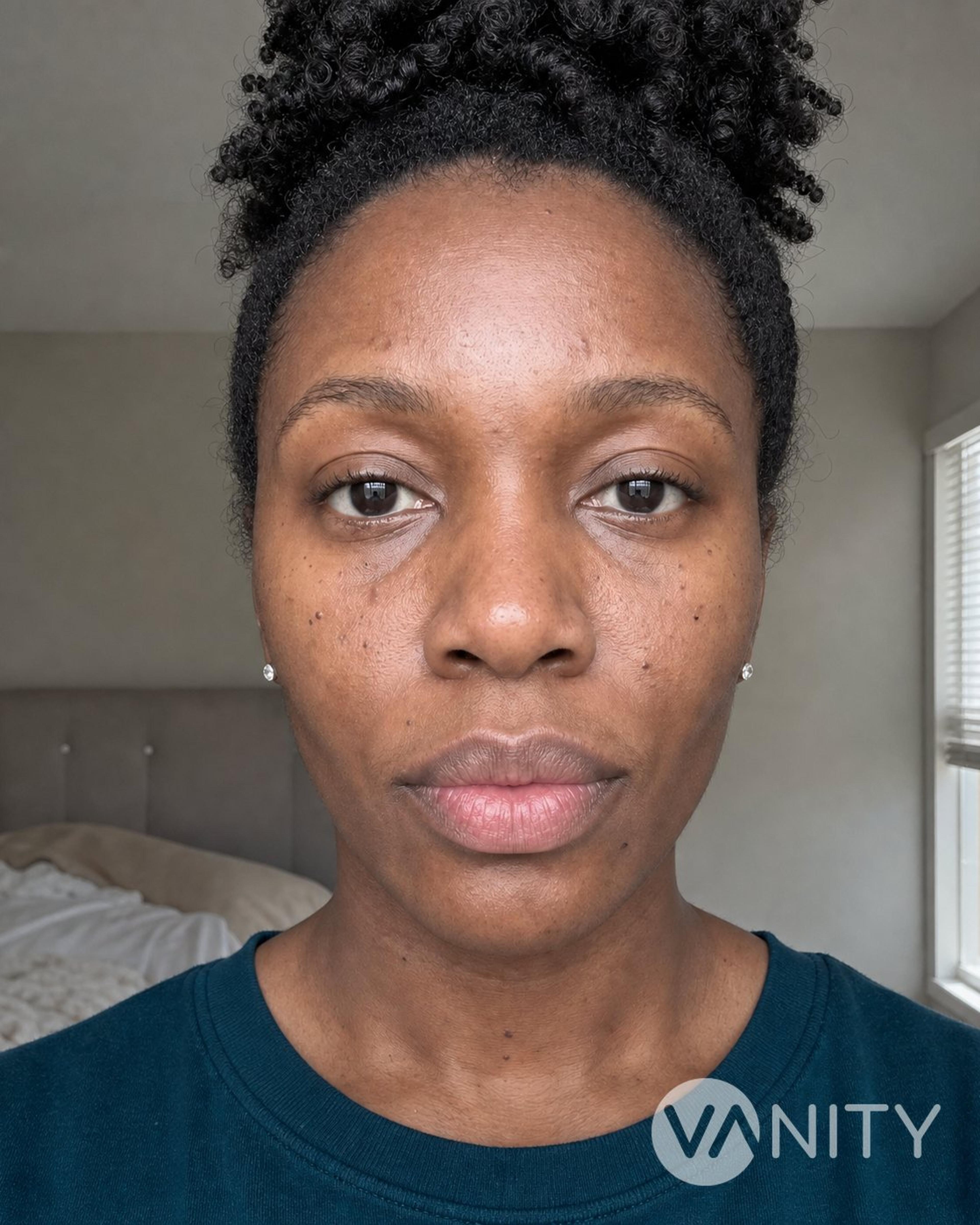 After Filler dissolving — illustrative, not a real patient
