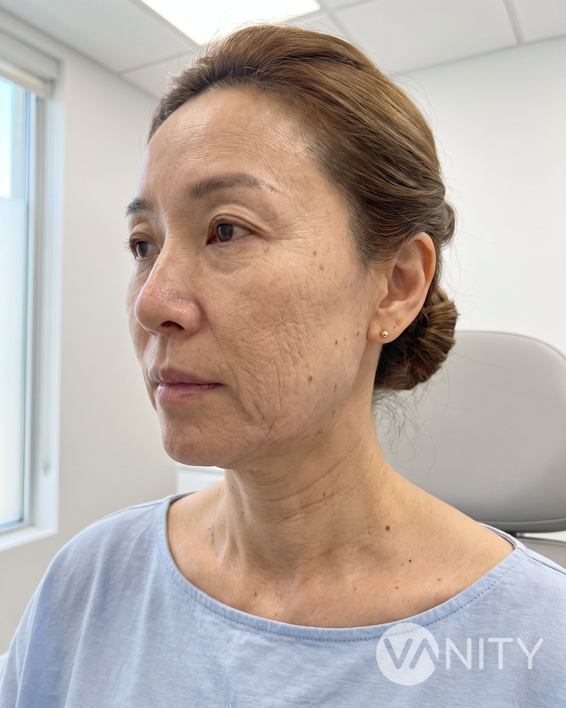Before Skin boosters — illustrative, not a real patient