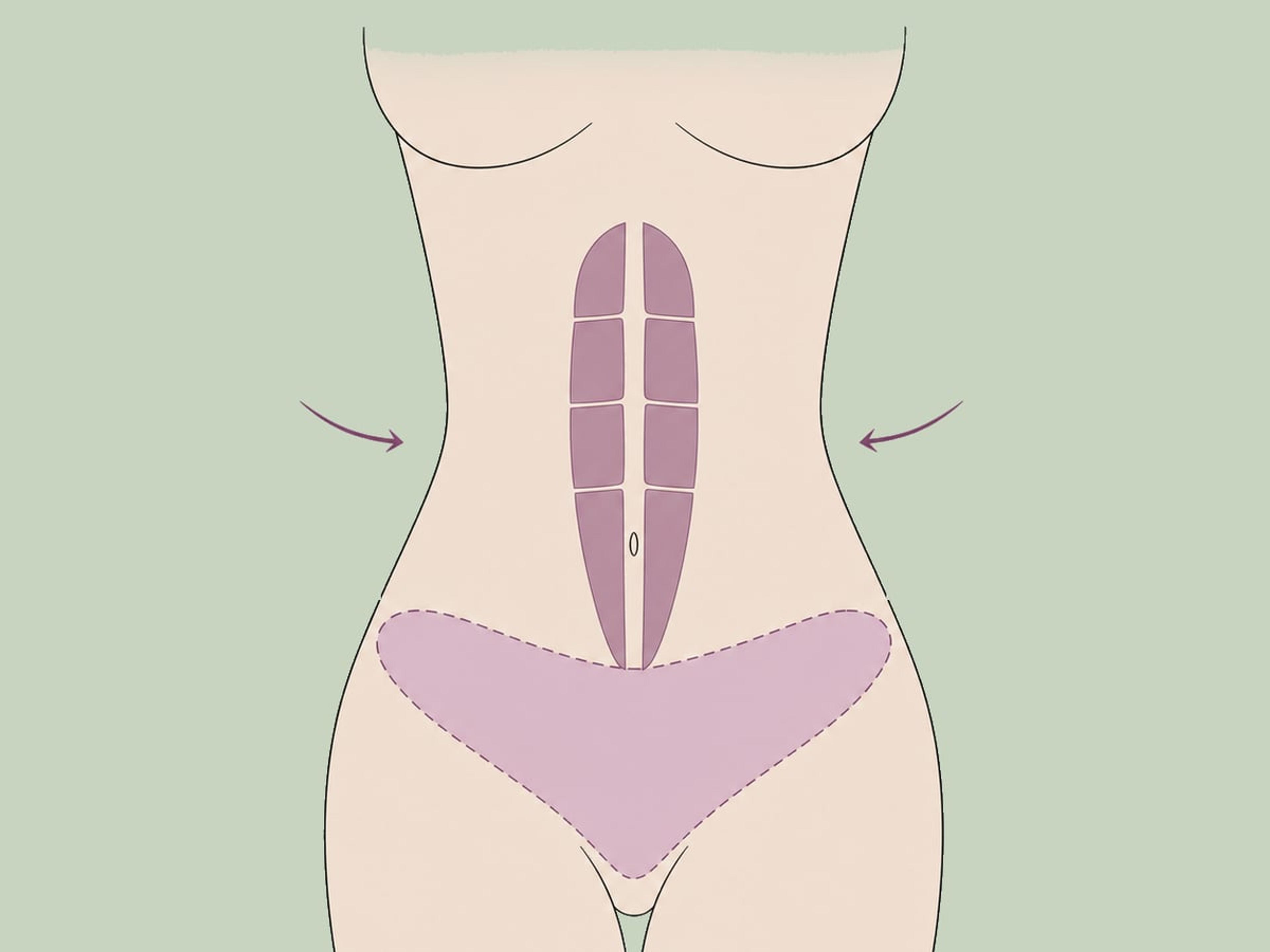 Lipoabdominoplastik — illustration