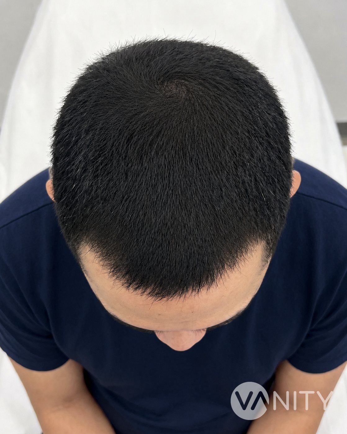 After PRP therapy — illustrative, not a real patient