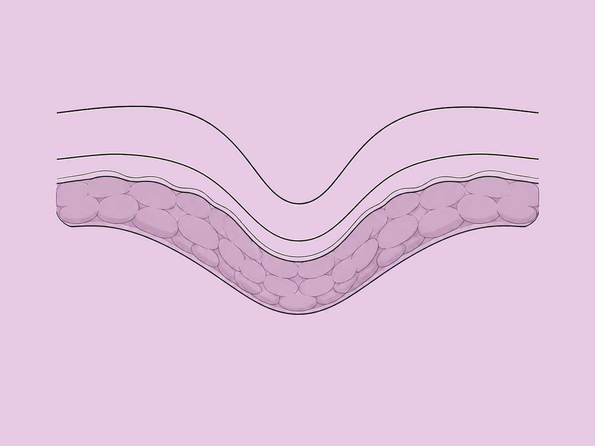 Fetttransplantation der großen Schamlippen — illustration