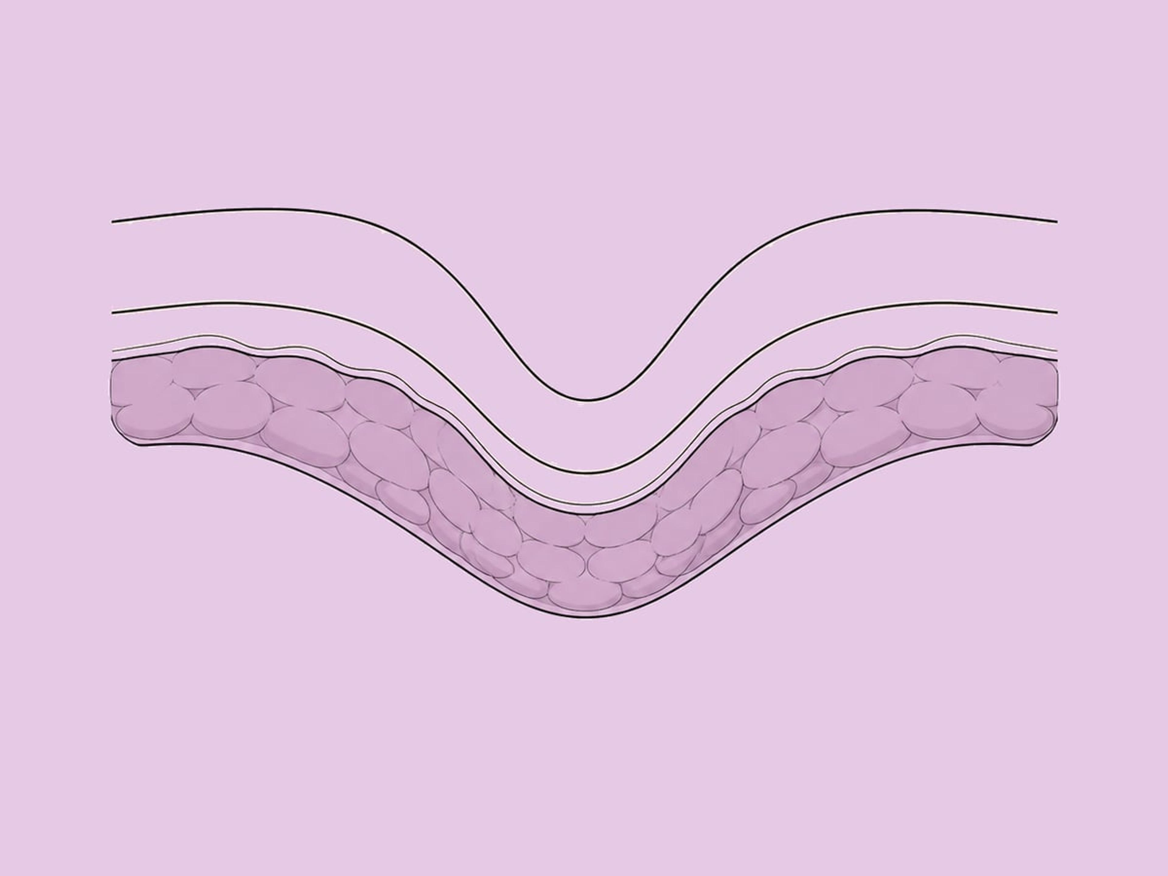 Fetttransplantation der großen Schamlippen — illustration