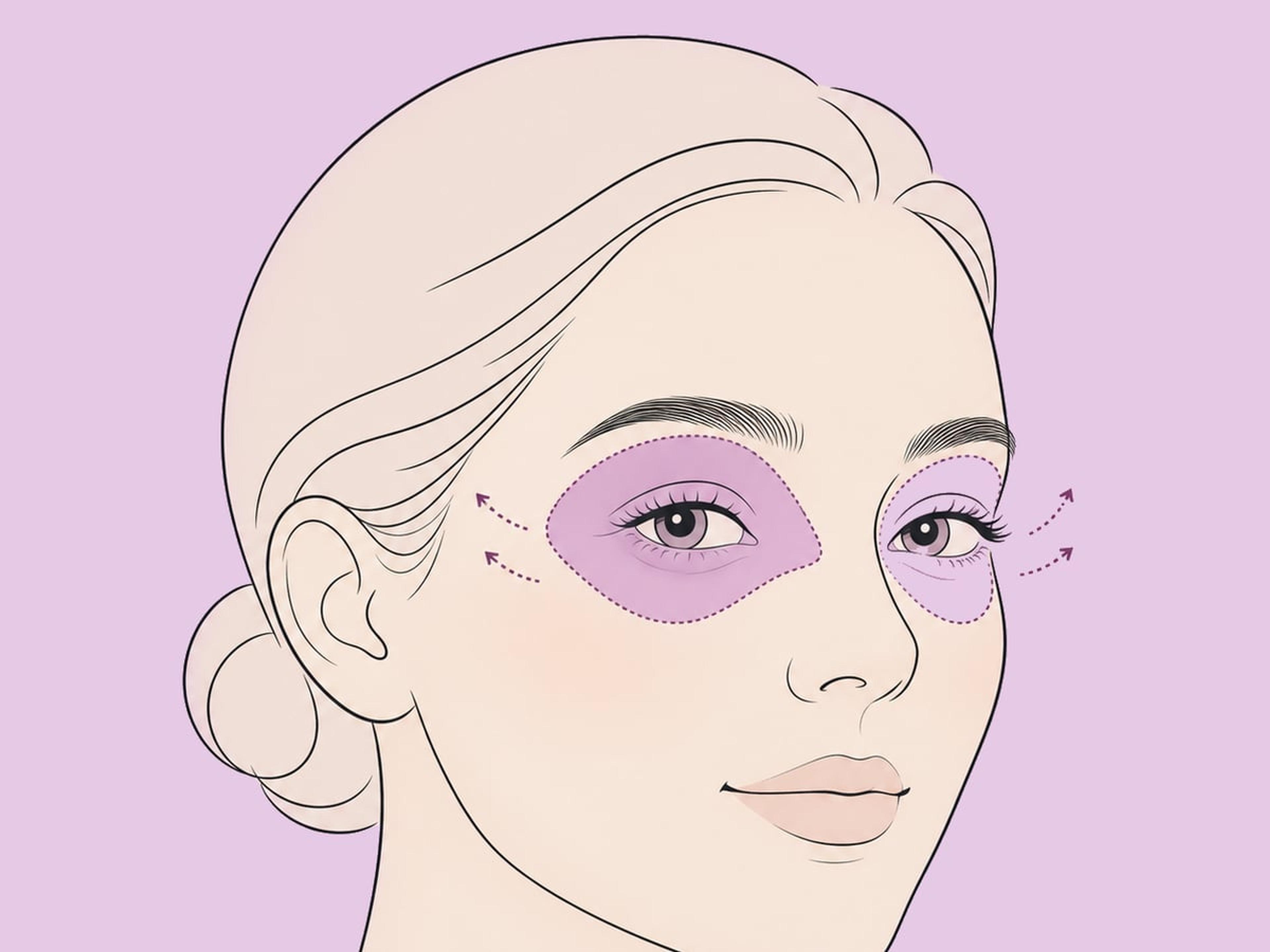 Kombinierte Ober- und Unterlidstraffung — illustration