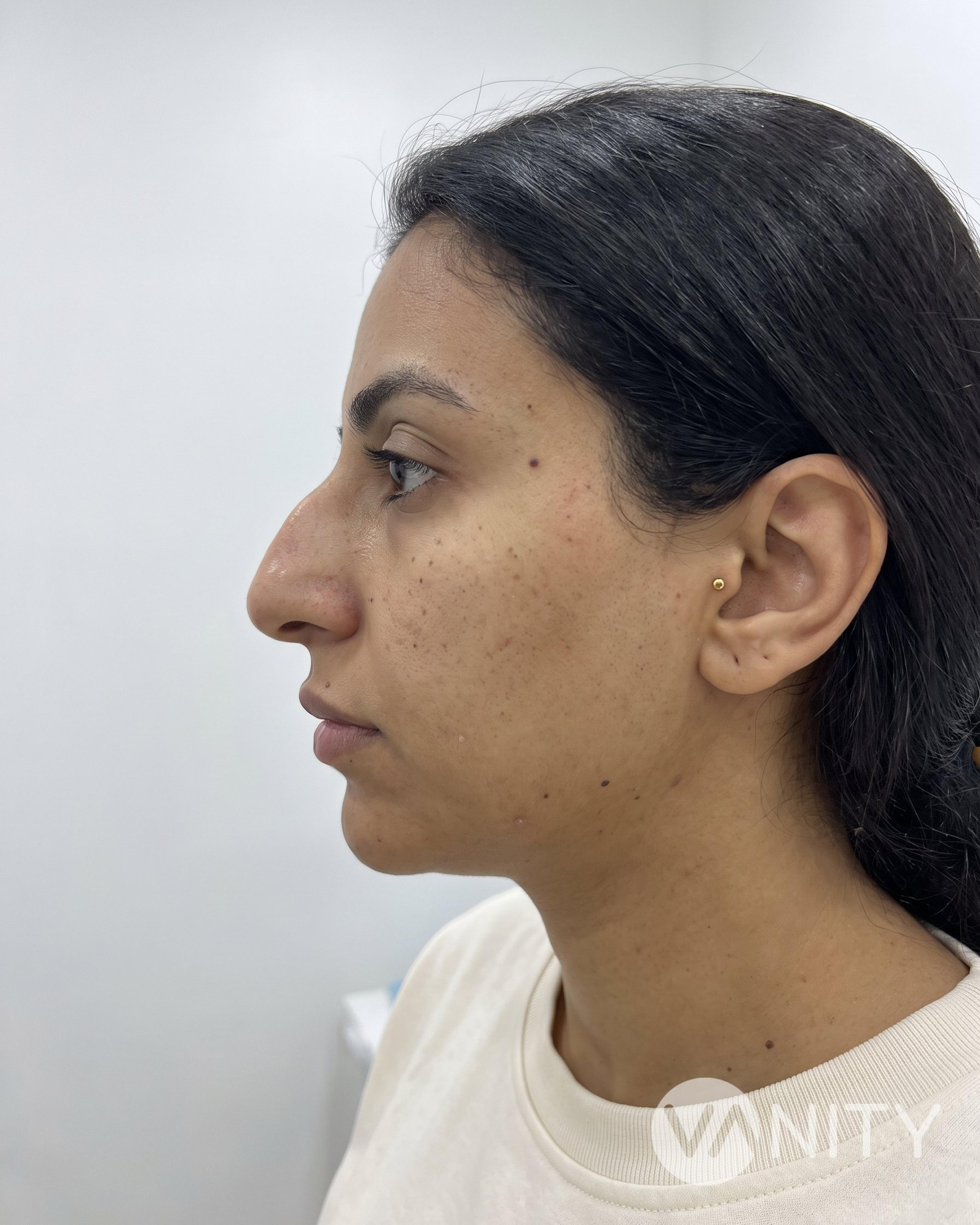 Before Non-surgical rhinoplasty — illustrative, not a real patient