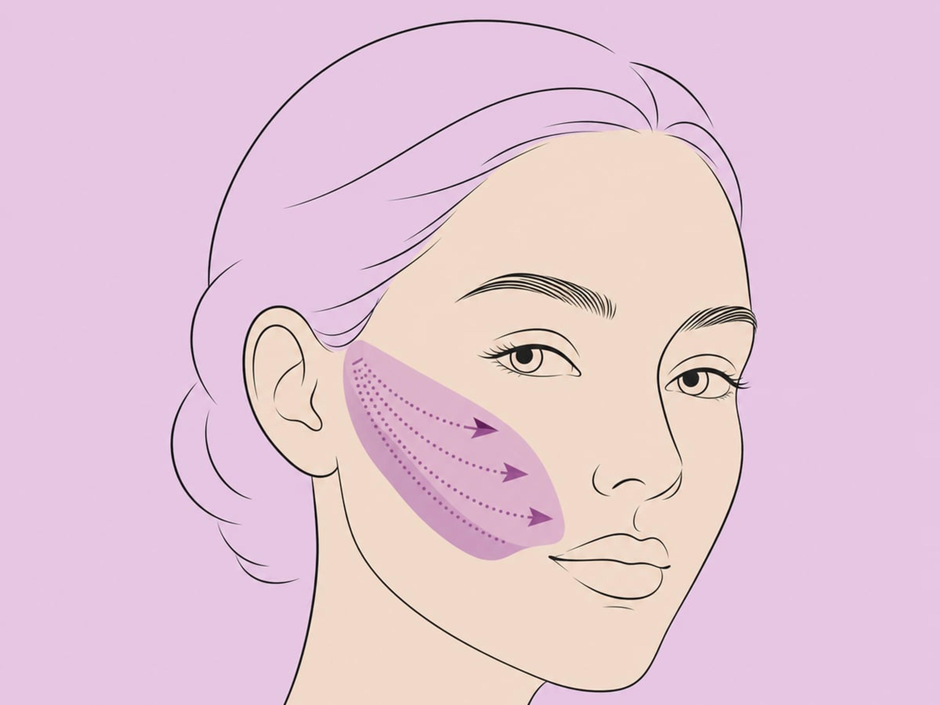 Strukturelle Fetttransplantation — illustration