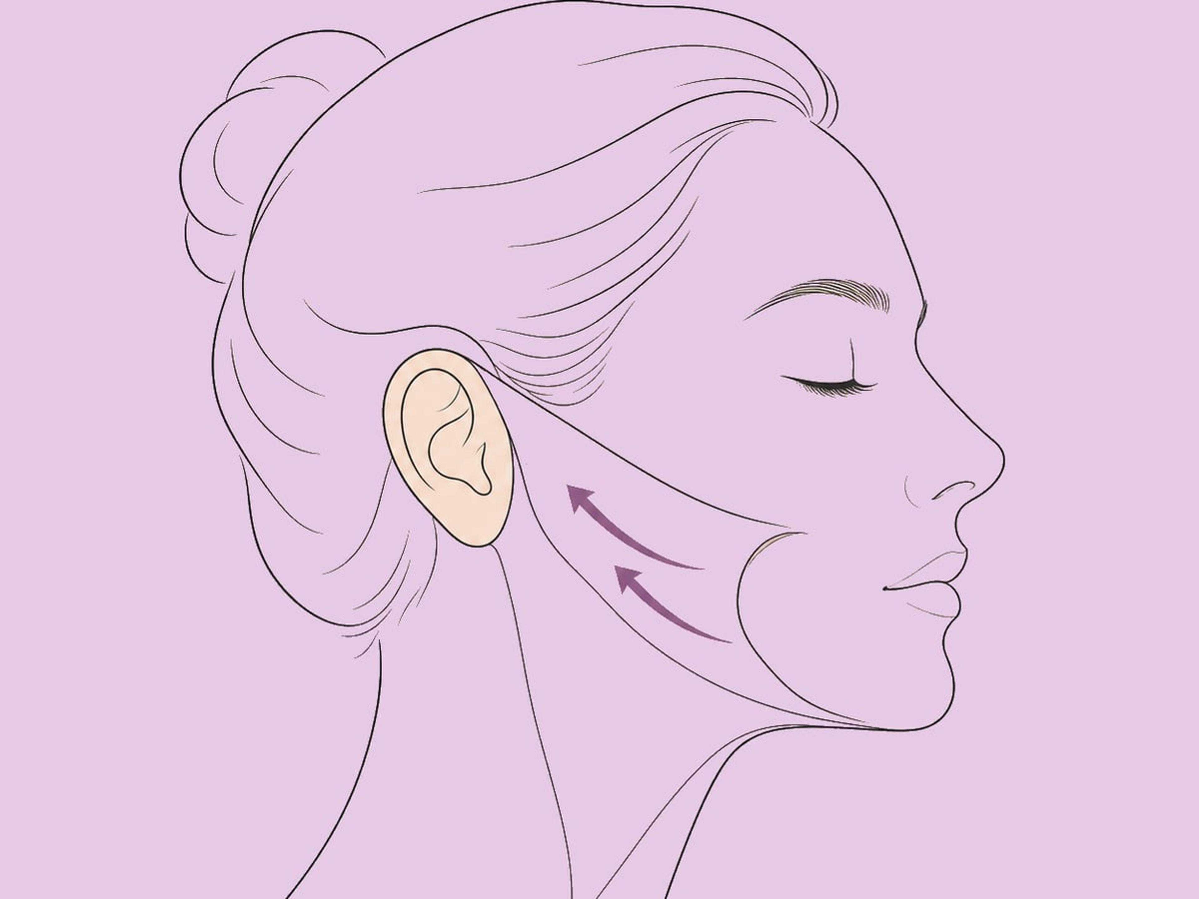 SMAS-Facelift — illustration