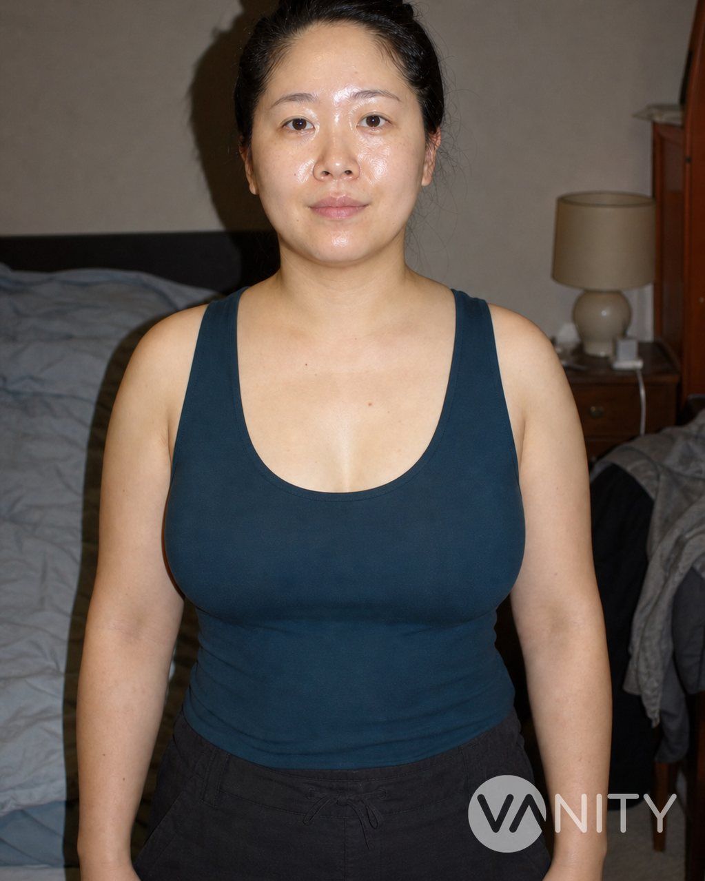 After Breast fat transfer — illustrative, not a real patient