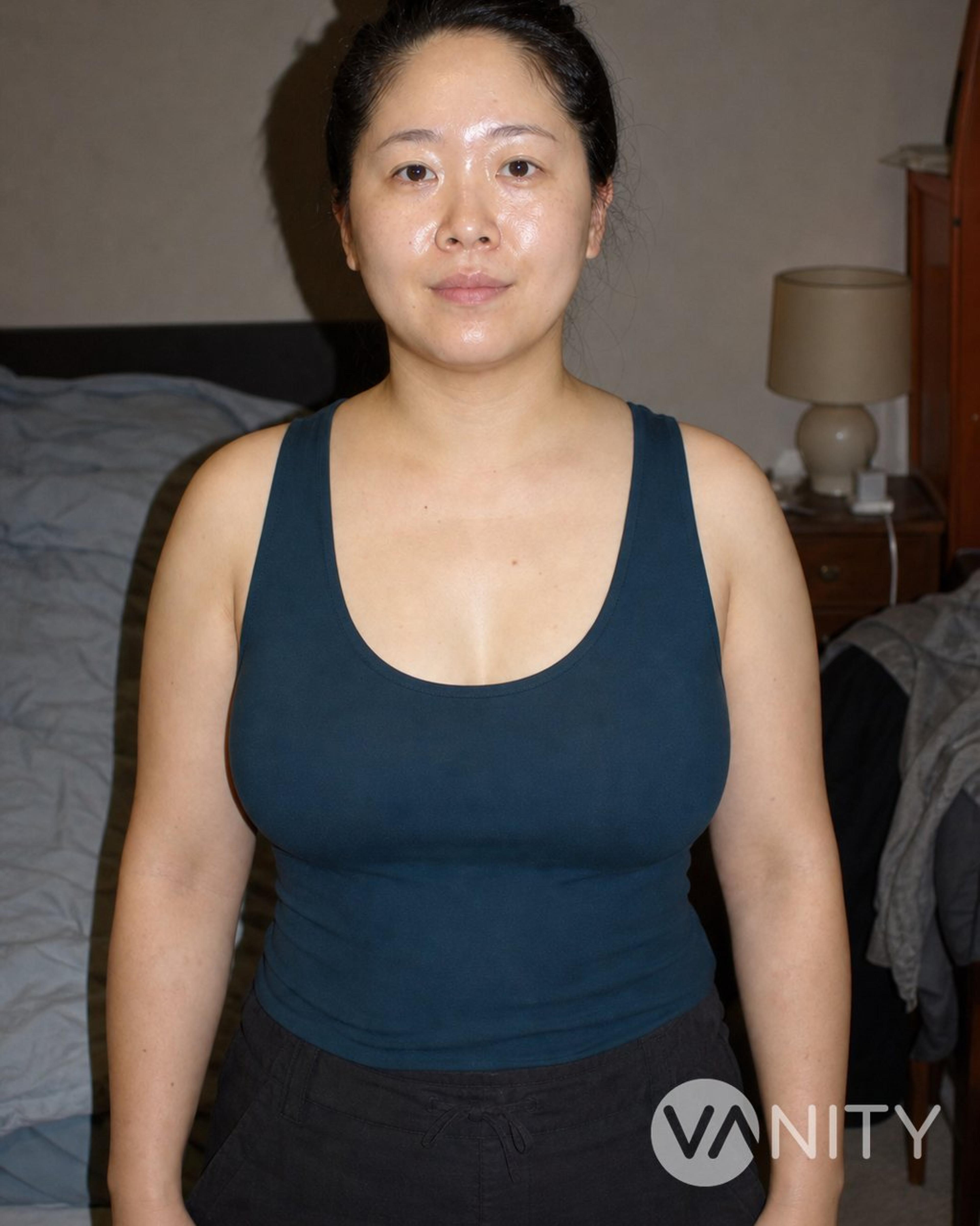 After Breast fat transfer — illustrative, not a real patient