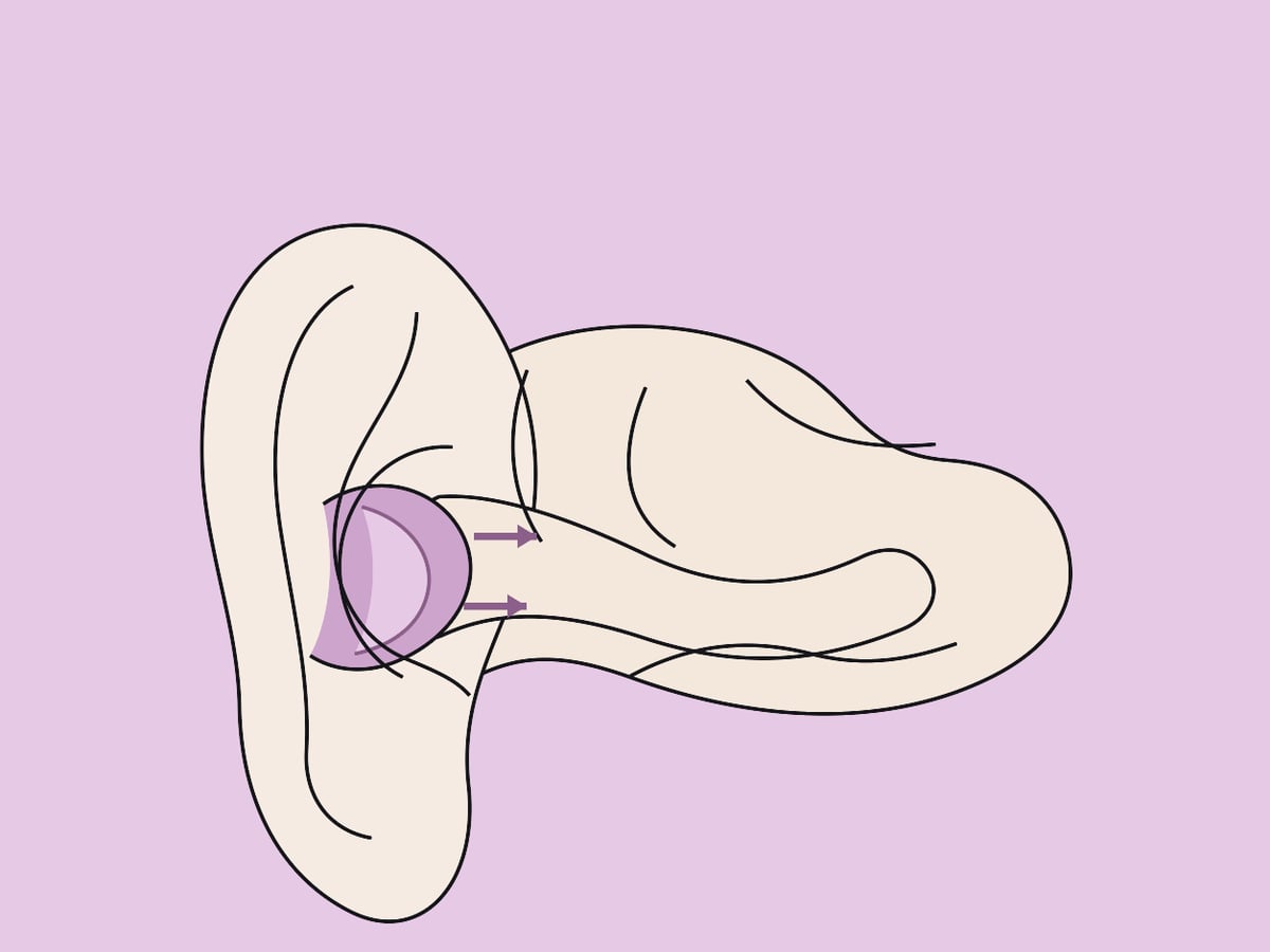 Knorpelexzision — illustration