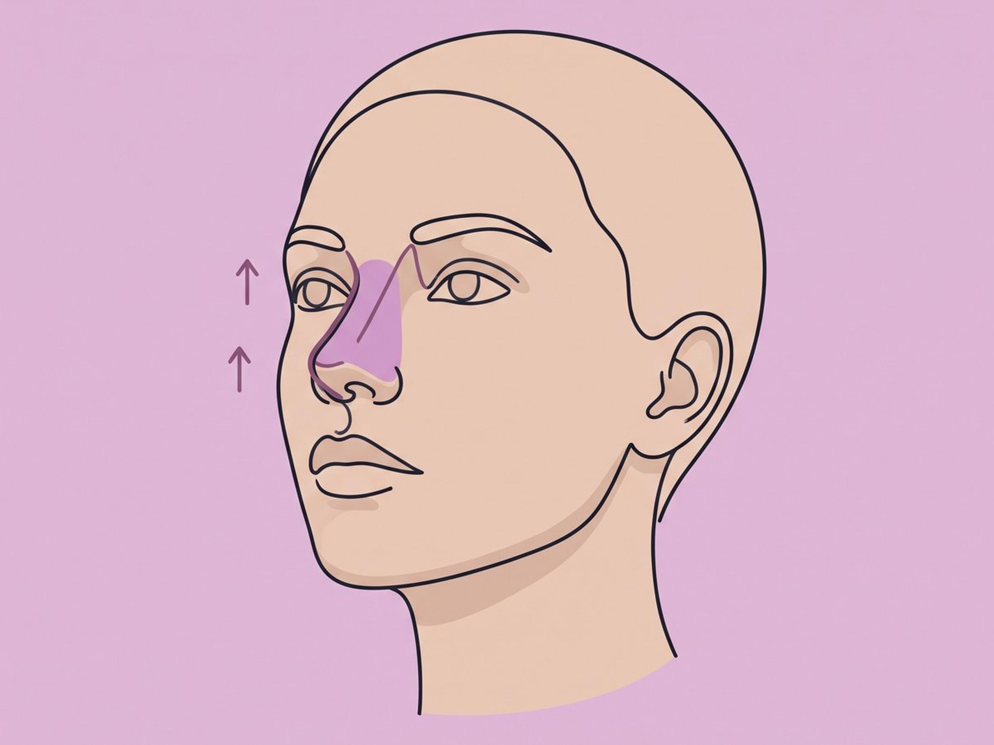 Aufbau des Nasenrückens mit eigenem Knorpel — illustration