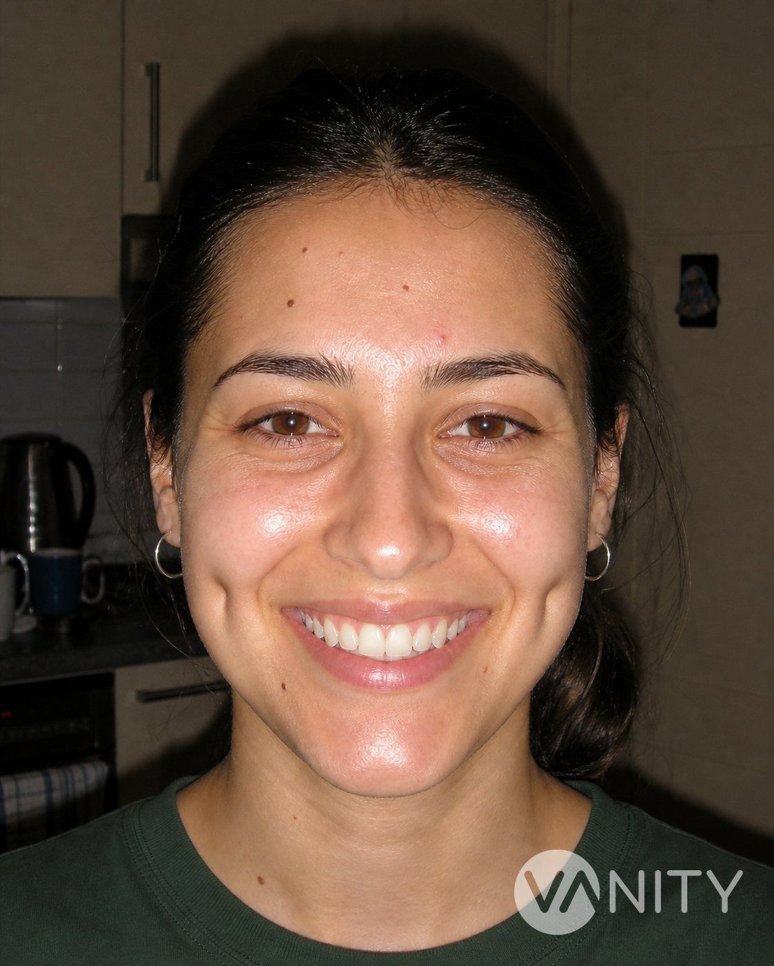 After Dimple surgery — illustrative, not a real patient