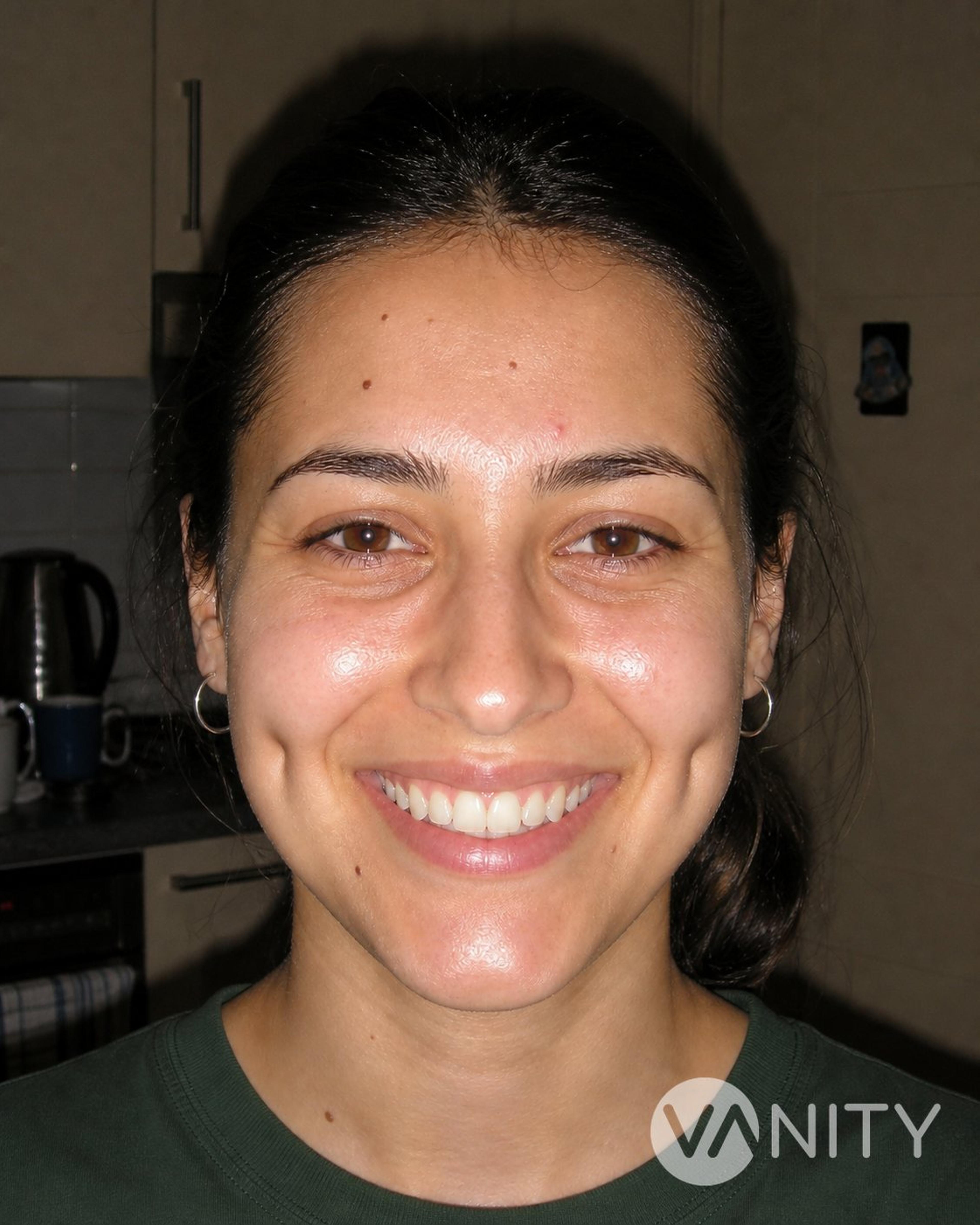 After Dimple surgery — illustrative, not a real patient