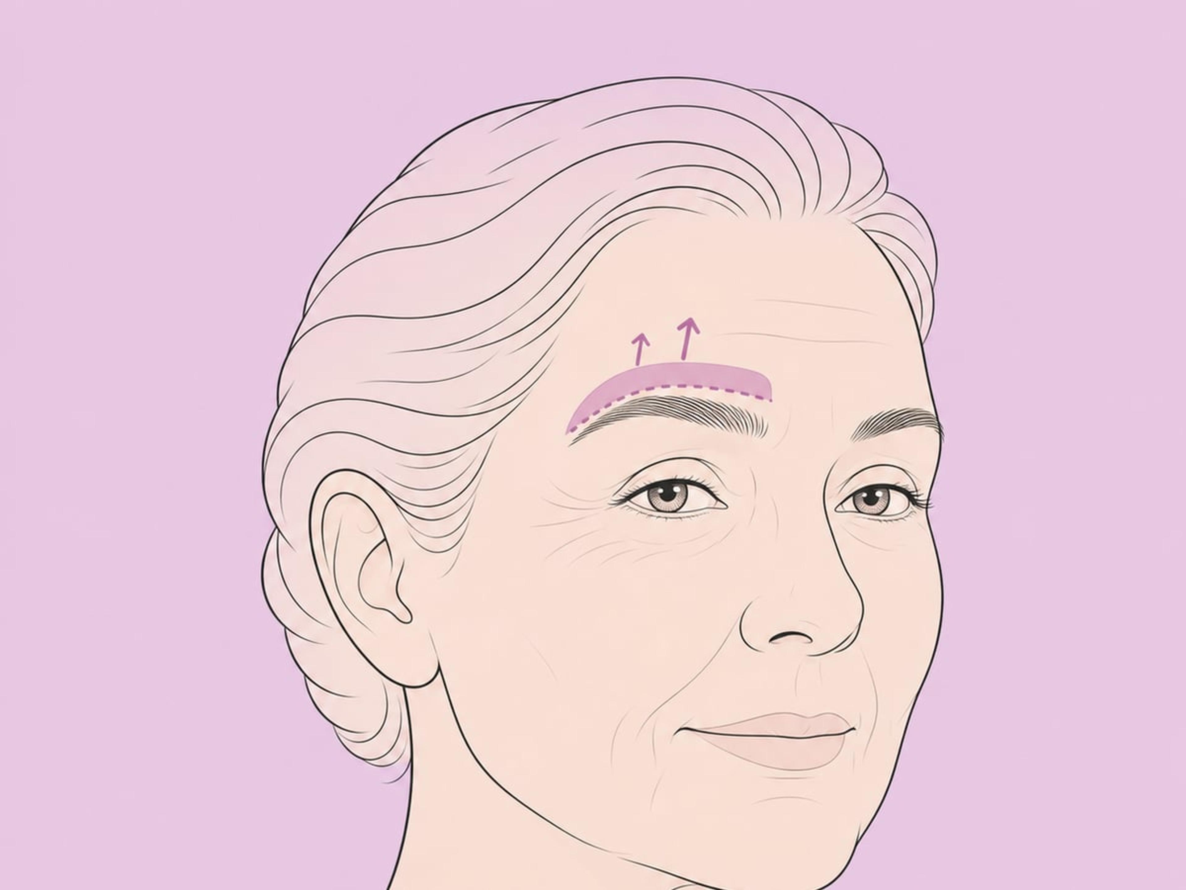 Direkter Stirnlift — illustration