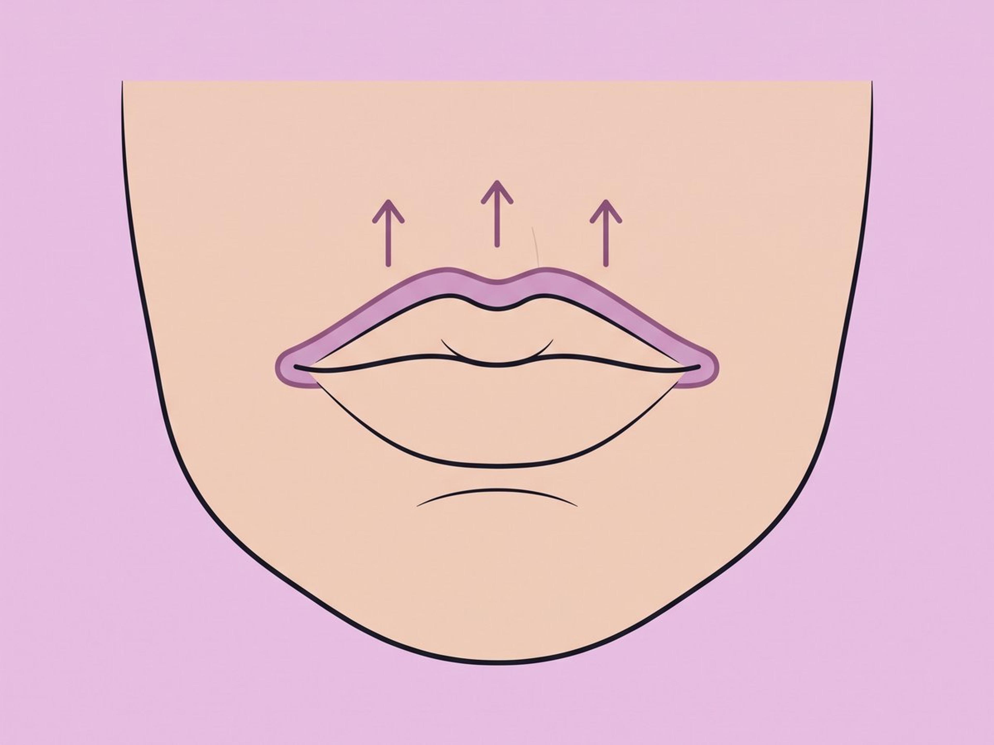 Direktes (Gullwing-)Lippenlifting — illustration