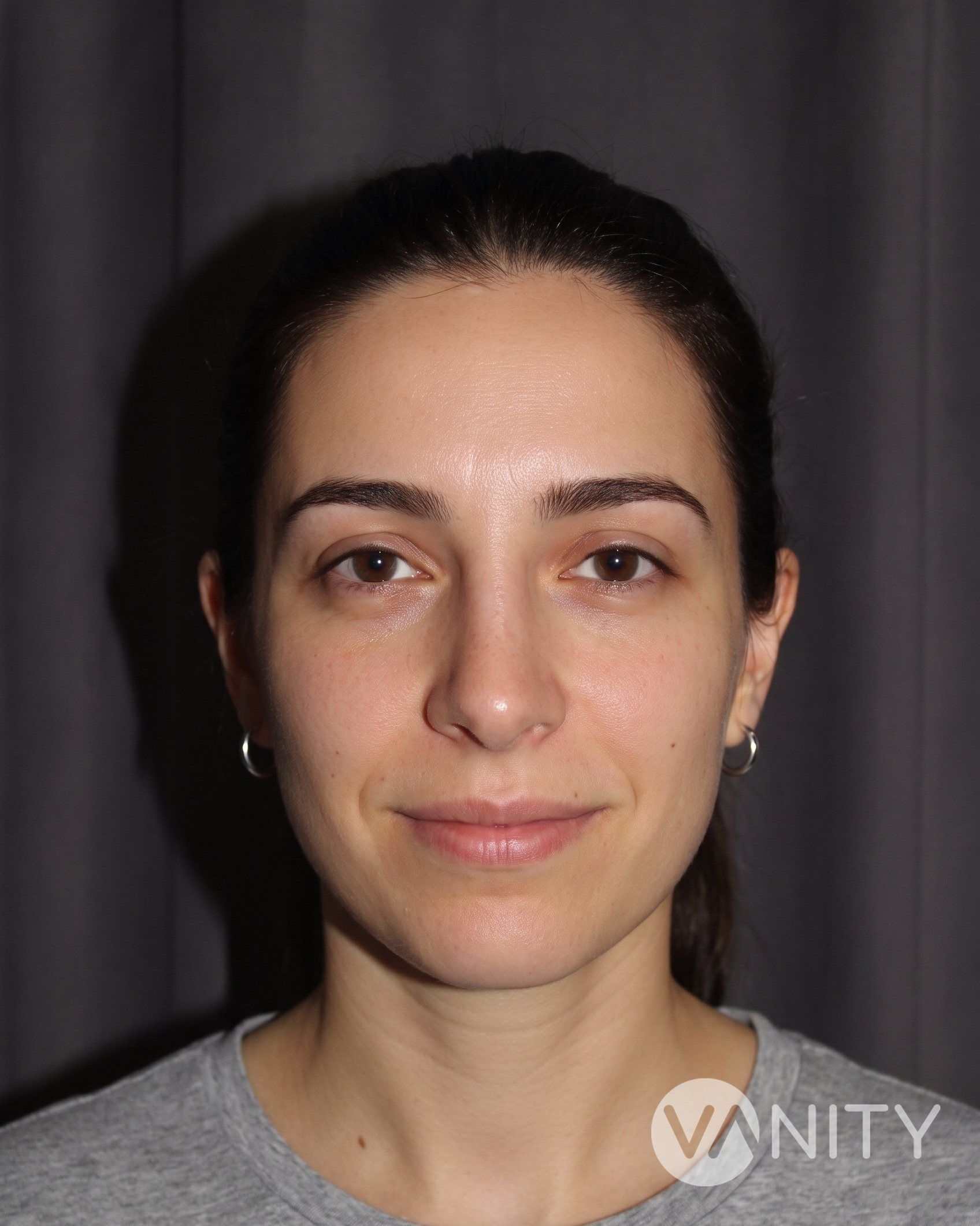 Rhinoplastik