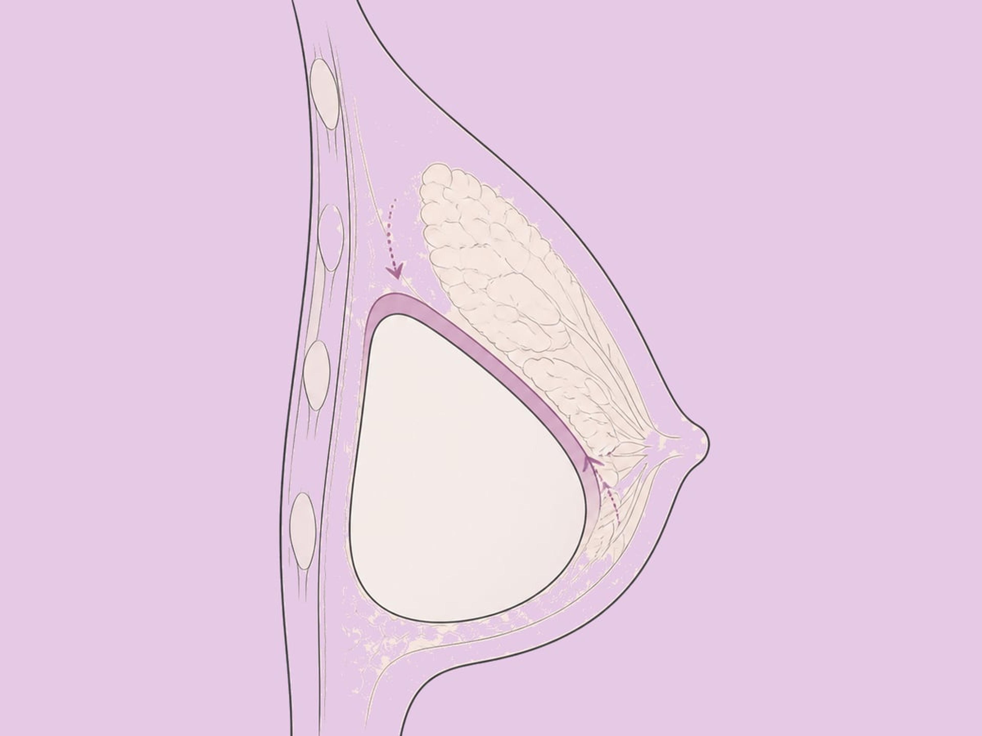 Kombinierte Brustvergrößerung — illustration