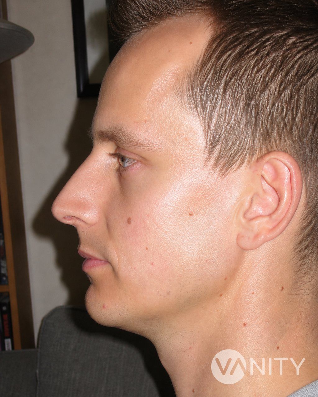 After Secondary rhinoplasty — illustrative, not a real patient