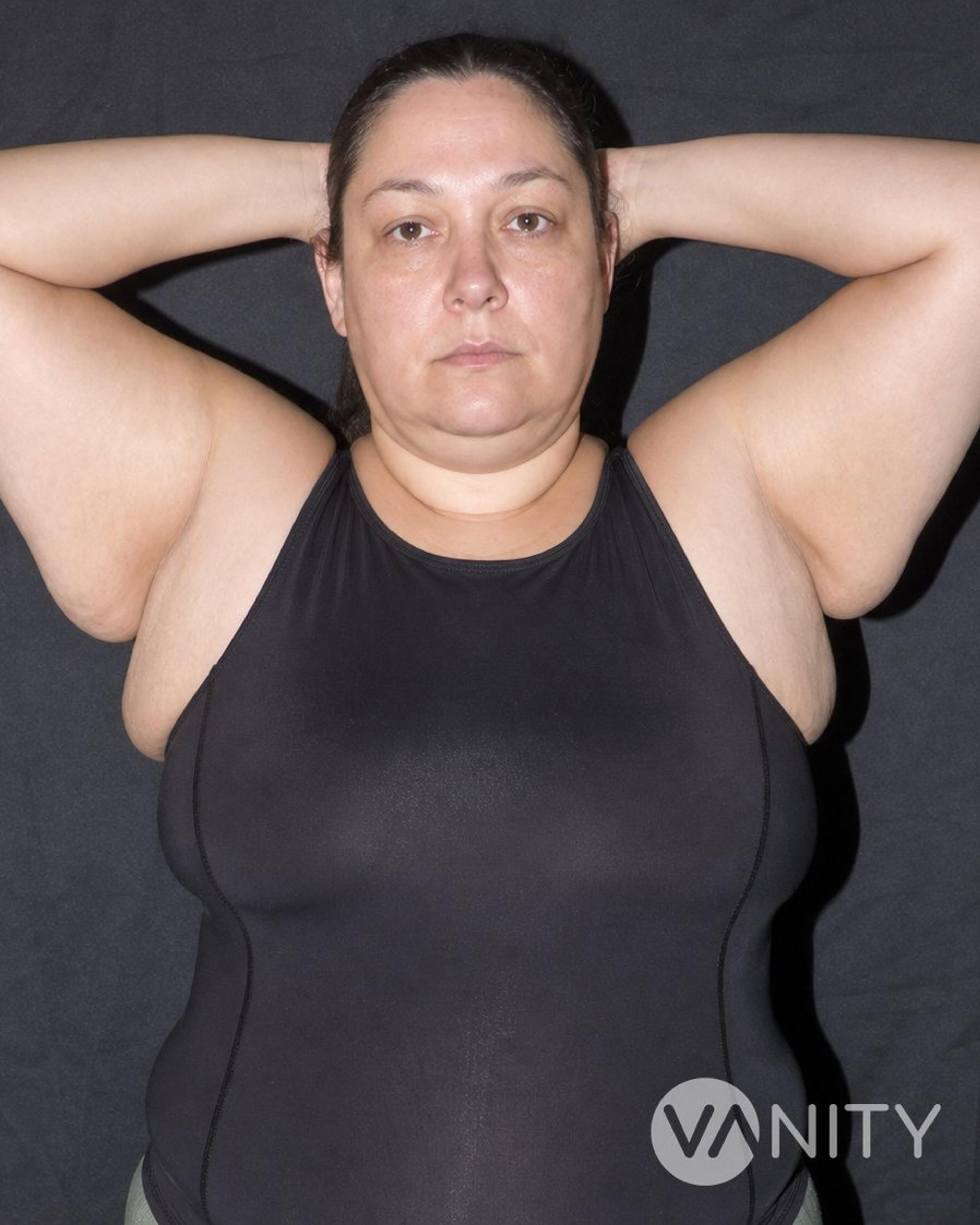Before Accessory breast removal — illustrative, not a real patient