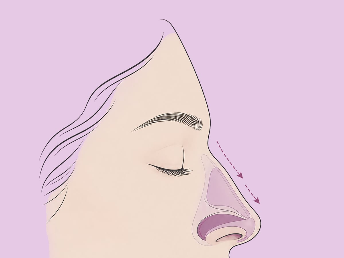 Geschlossene Rhinoplastik — illustration