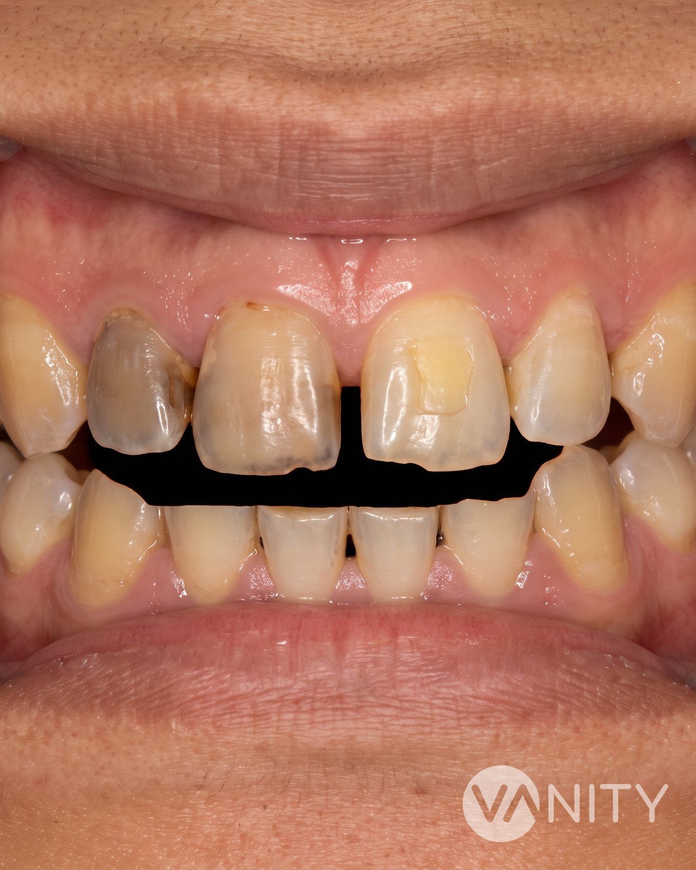 Before Dental veneers — illustrative, not a real patient