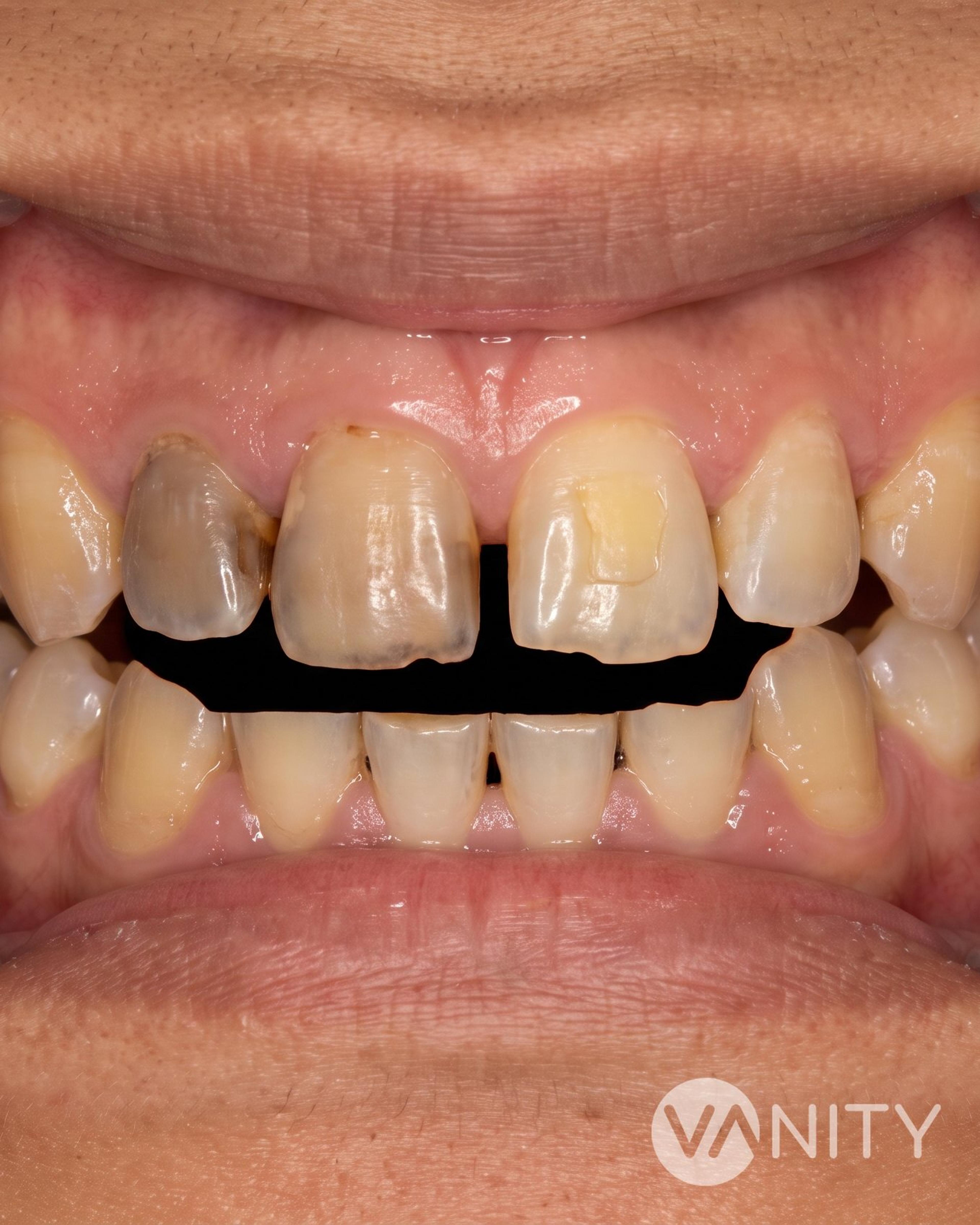 Before Dental veneers — illustrative, not a real patient