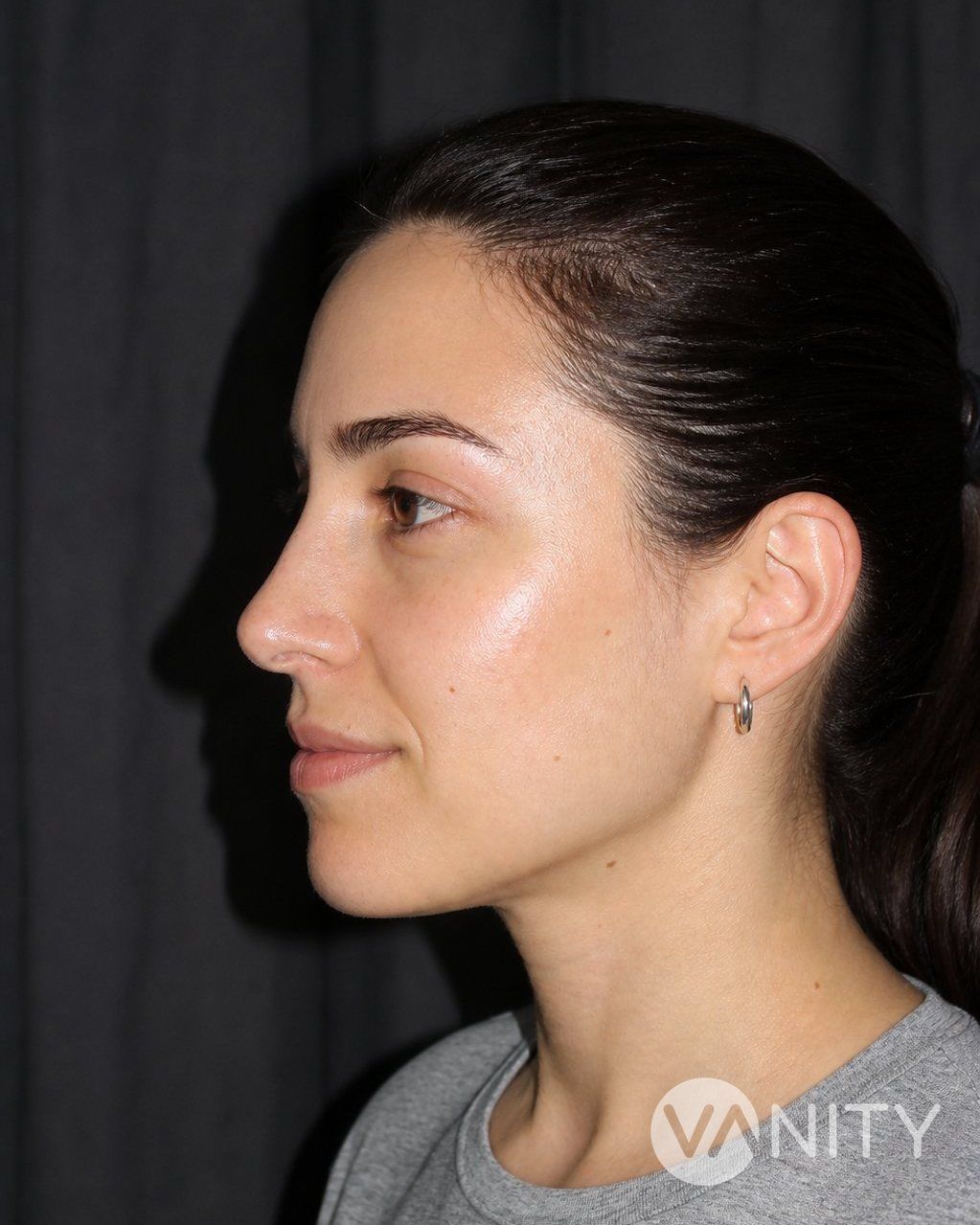 Rhinoplasty