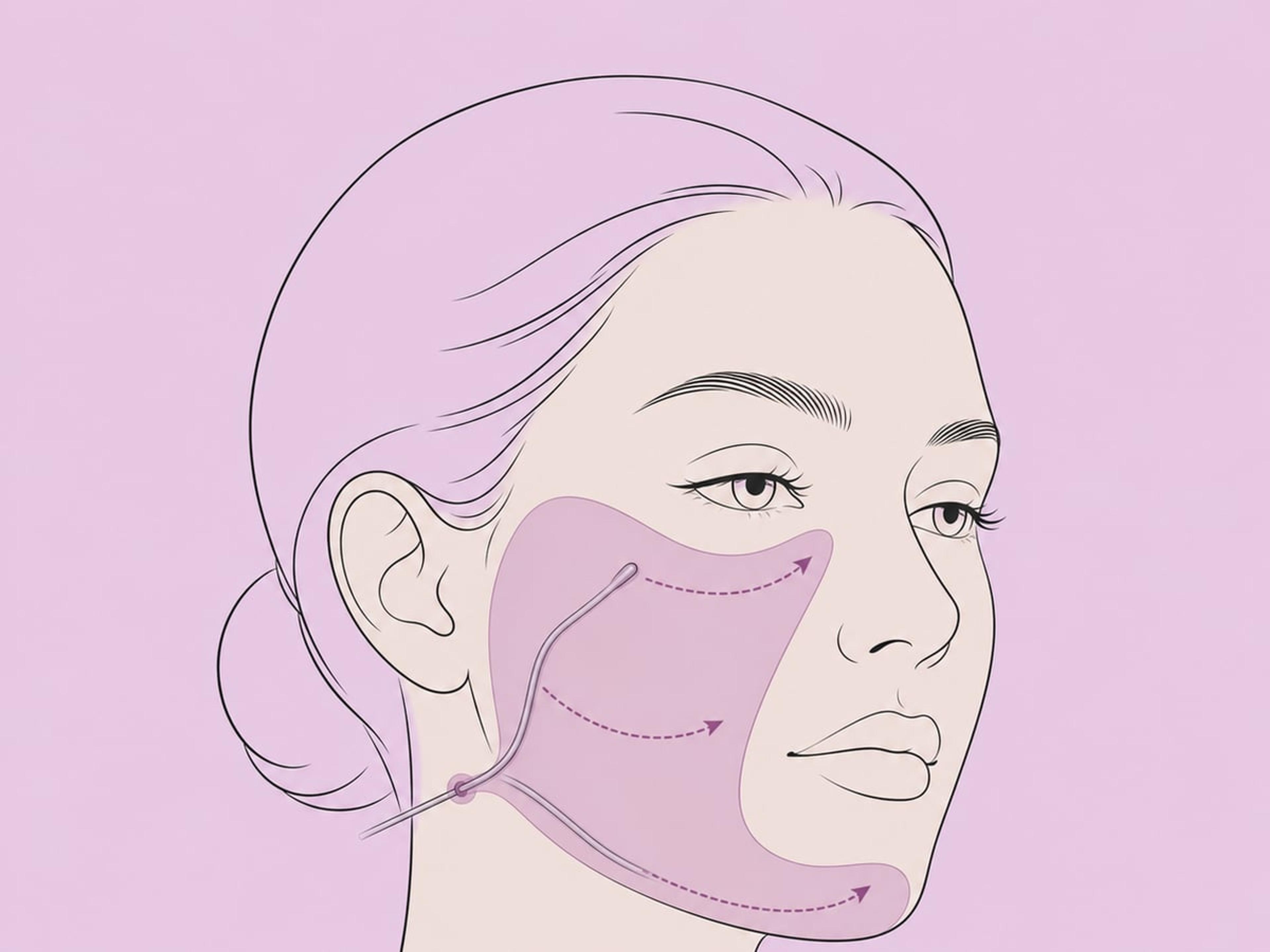 تقنية الكانيولا — illustration