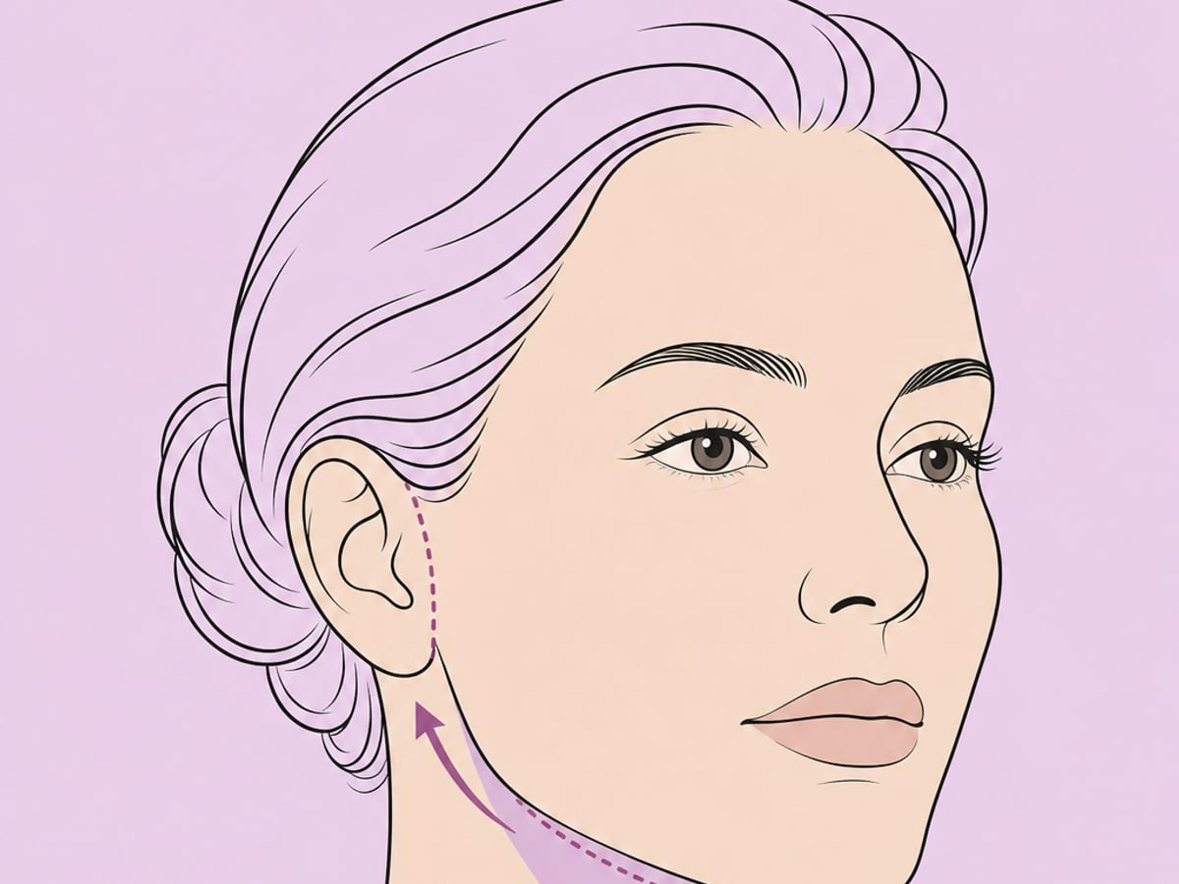 Zervikoplastik — illustration