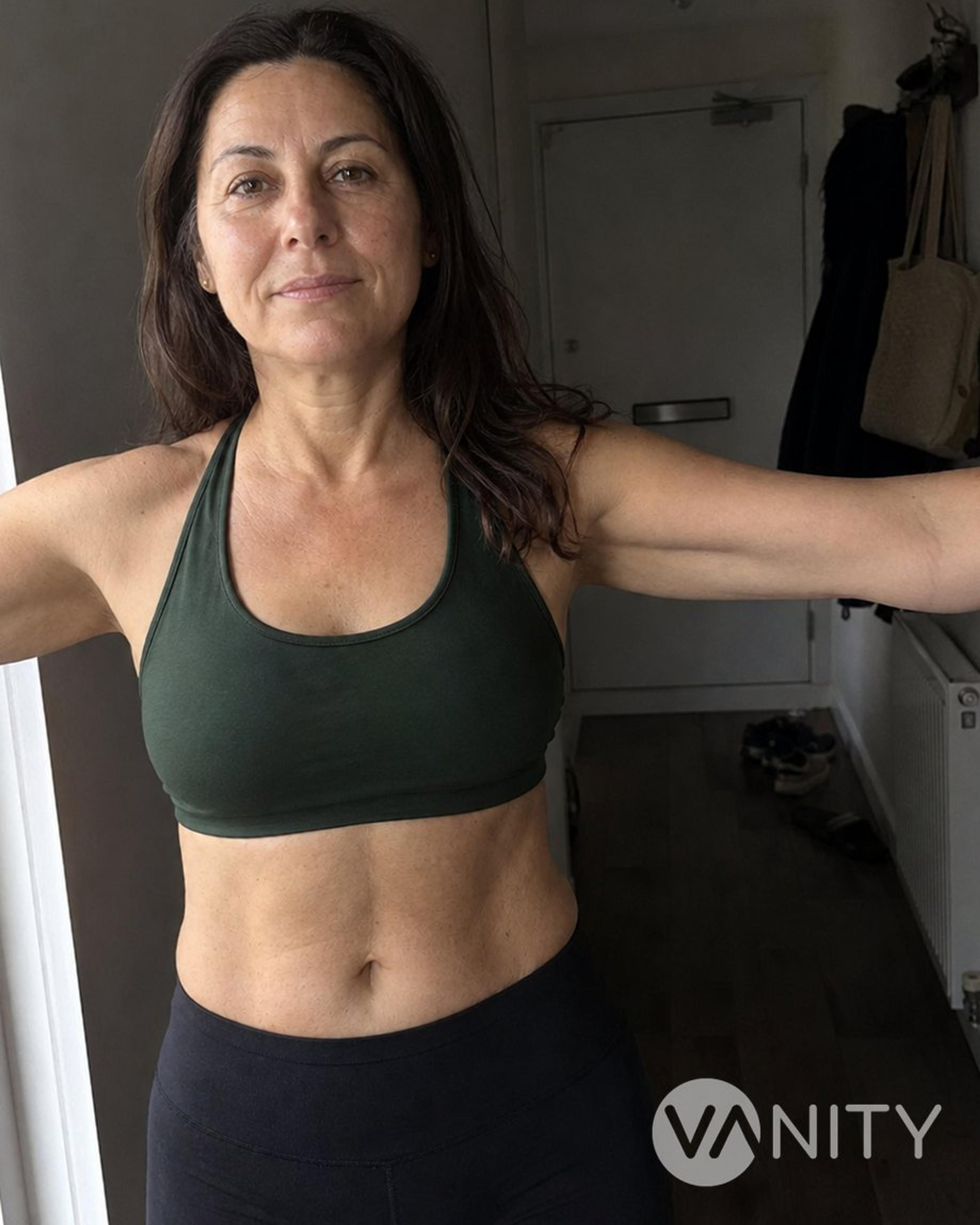 After Arm lift — illustrative, not a real patient
