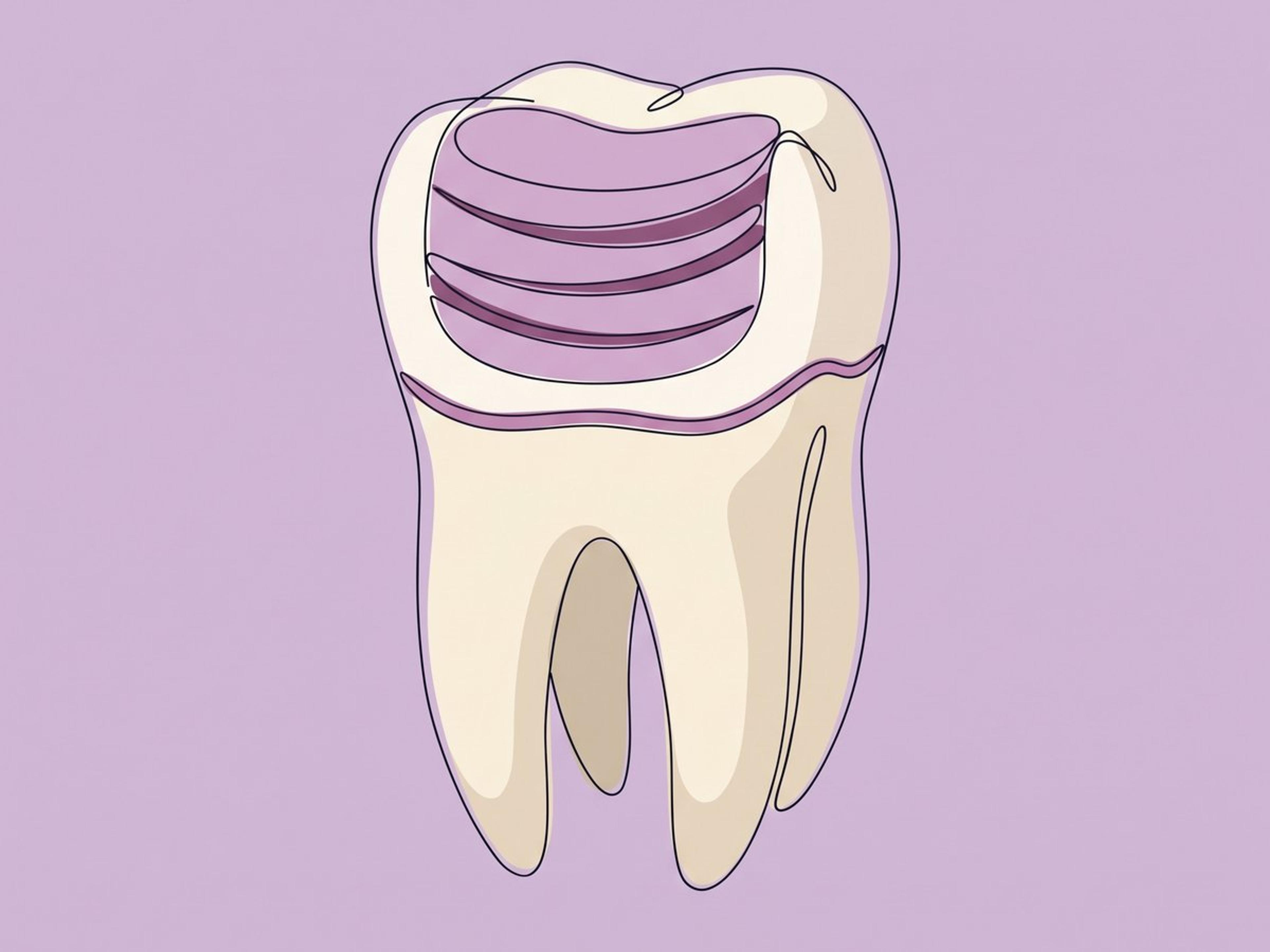 الكومبوزيت الراتنجي — بلون السن، يوضع مباشرة — illustration